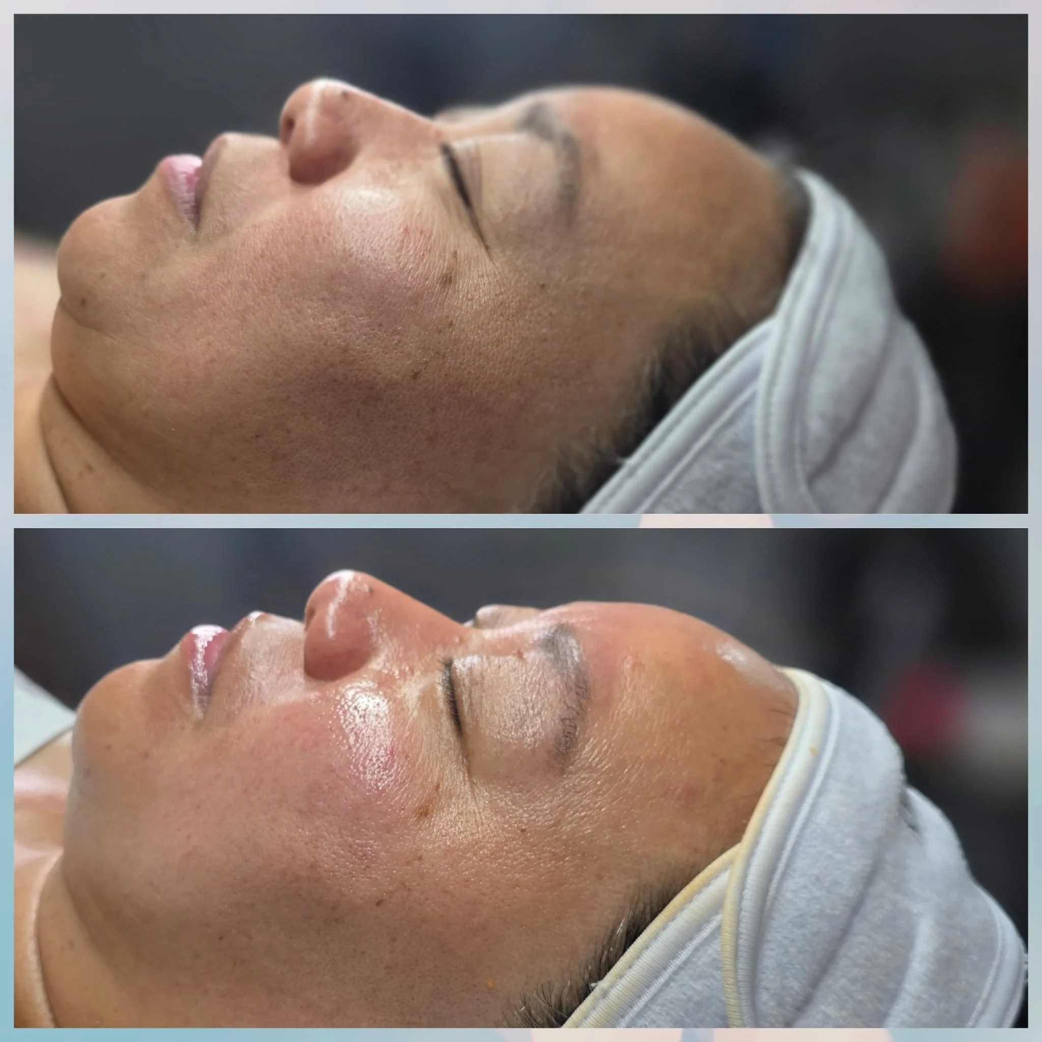 Comparison of a woman's face before and after a skincare treatment, showing smoother and more radiant skin in the after image.