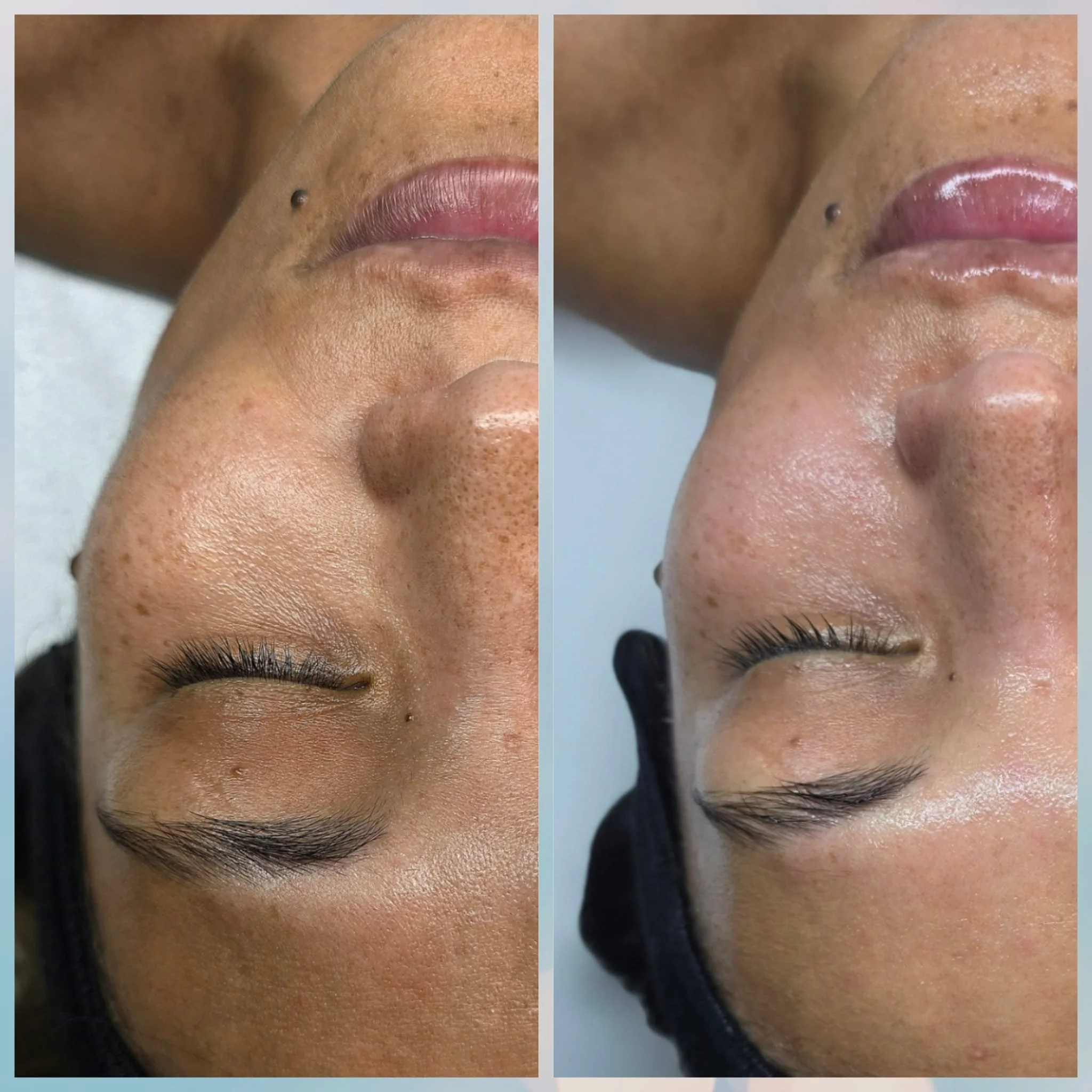 Side-by-side comparison of a person's face before and after a skincare treatment, showing improved skin texture and appearance.