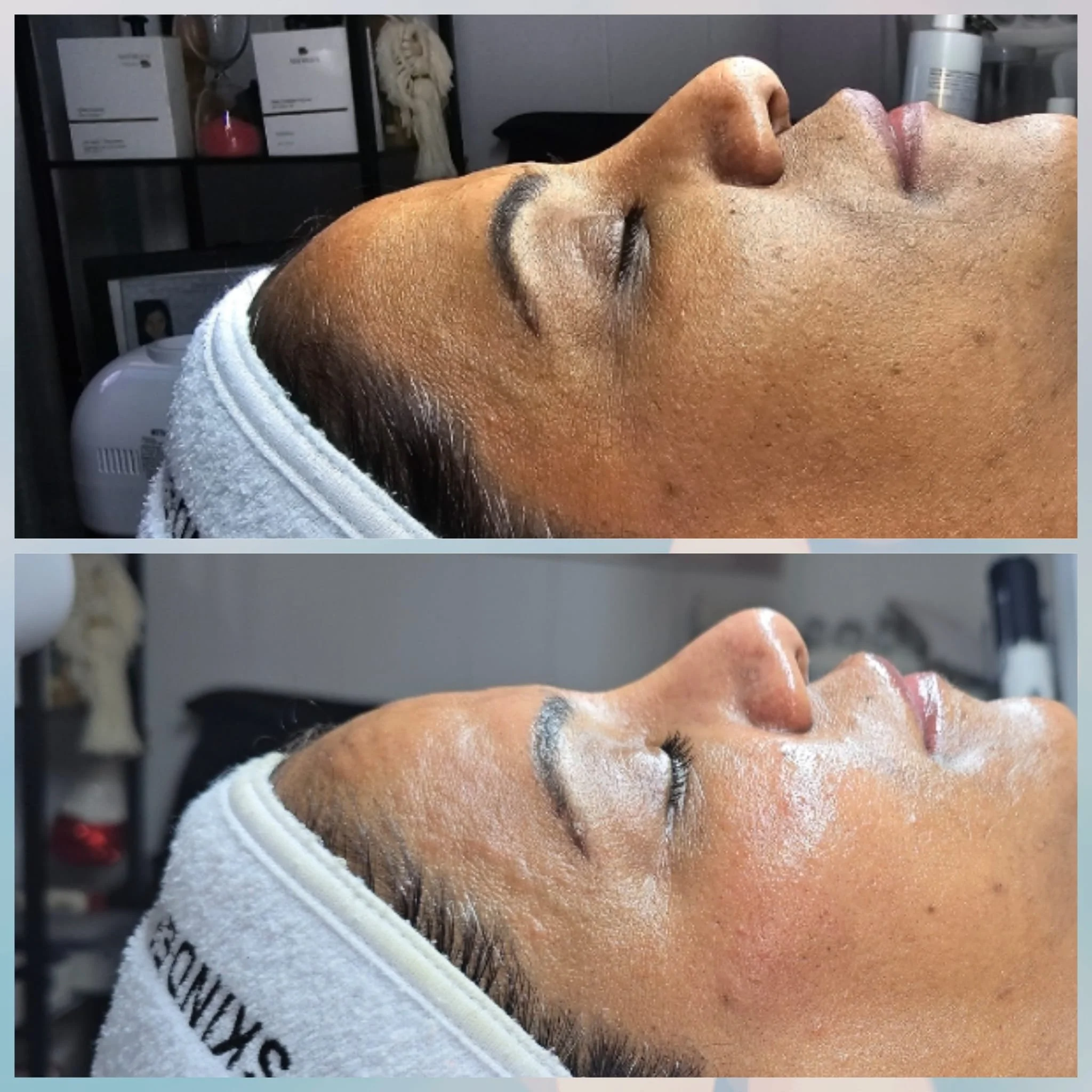 Comparison of a woman receiving a facial treatment before and after skincare, showing improved skin texture and moisture.