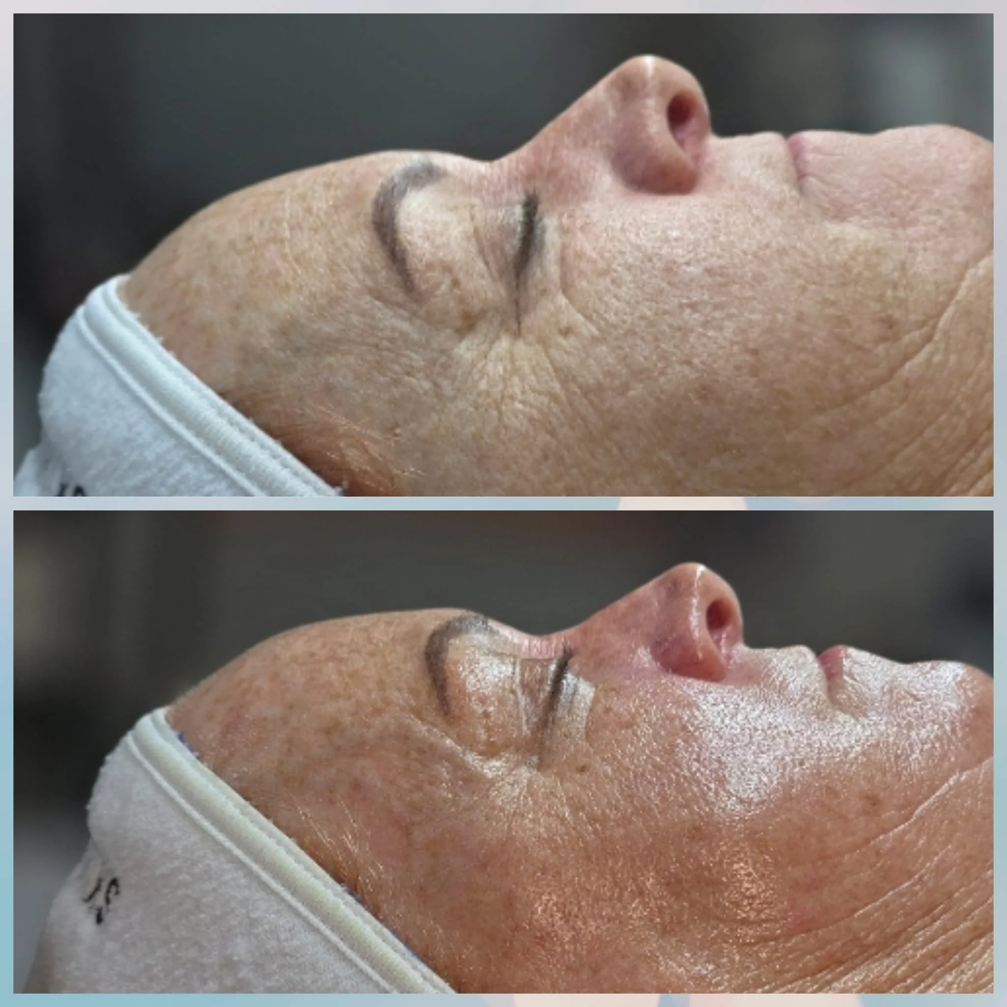Close-up of a woman's face showing before and after skincare treatment, with visibly smoother and more hydrated skin in the second image.