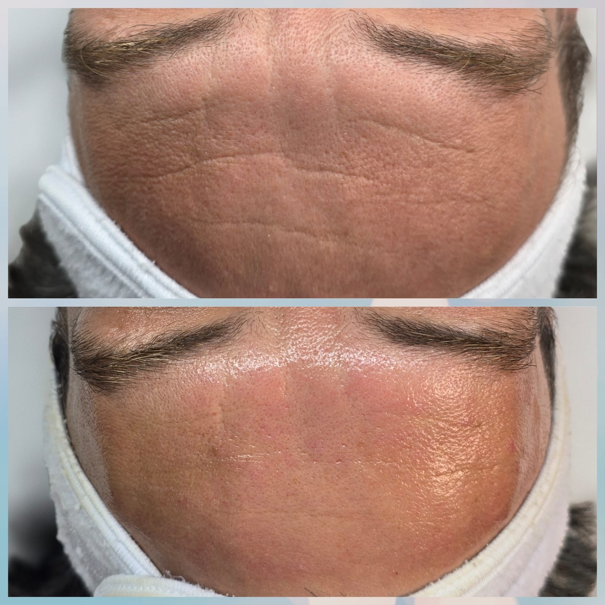 Close-up of a person's forehead before and after a skincare treatment, showing improved skin texture and reduced appearance of lines after the treatment.