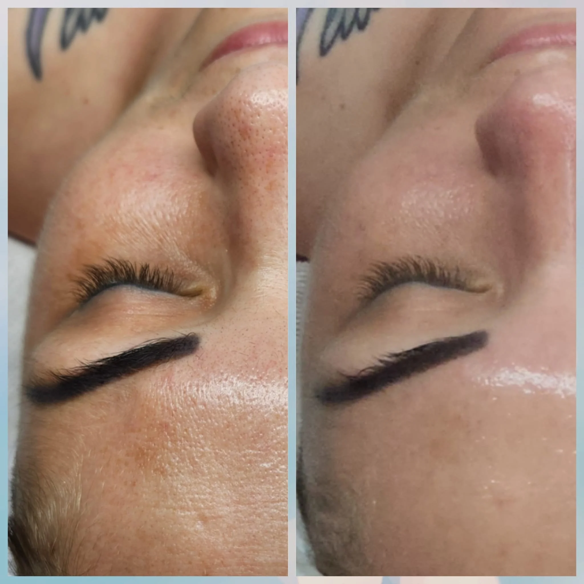 Close-up comparison of a person's forehead and nose before and after skincare treatment, showing reduced pore size and smoother skin.