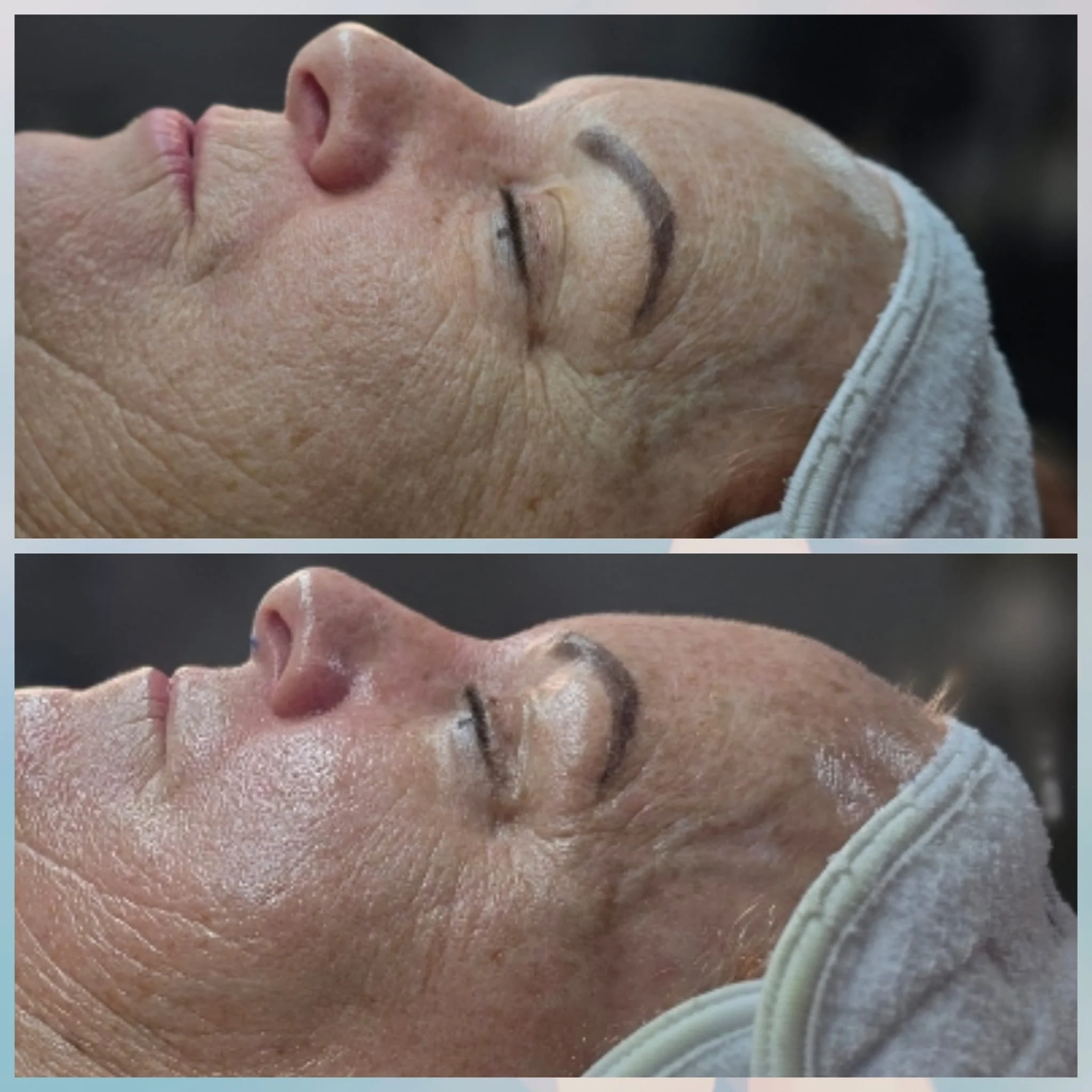 Side-by-side comparison of a woman's face before and after a skincare treatment, showing improved skin texture and reduced wrinkles.