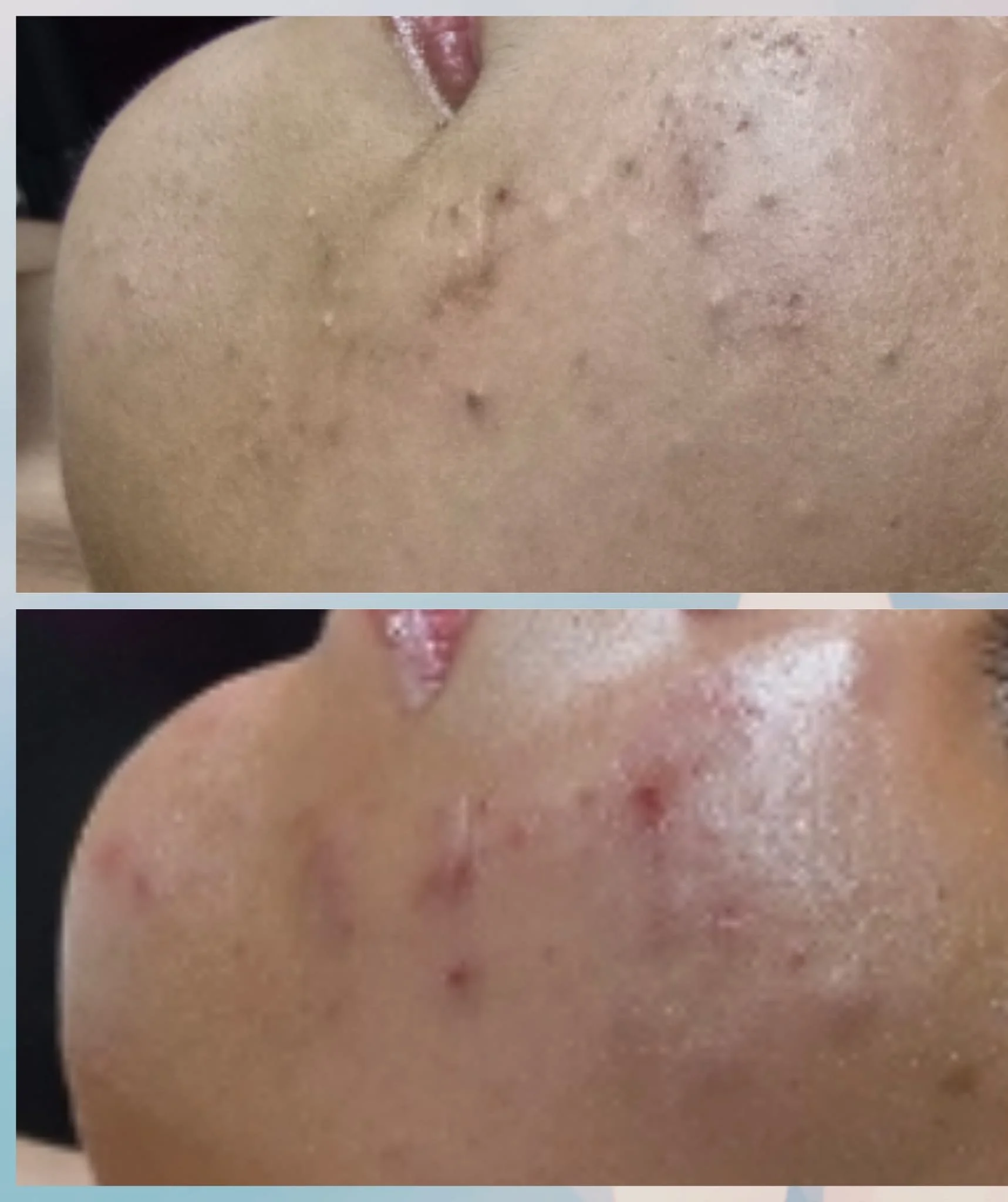 Comparison of a person's cheek before and after acne treatment, showing reduction in acne scars and pimples.