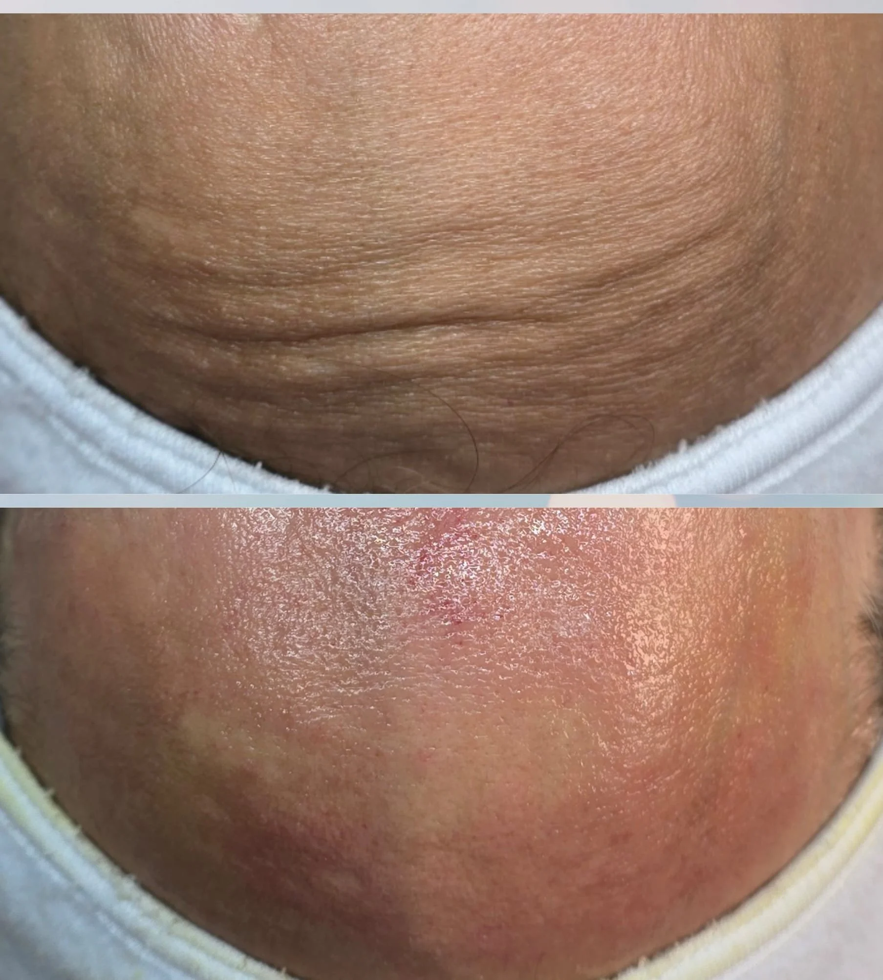A close-up comparison of a person's skin before and after a skin treatment, showing improvement in skin texture and appearance.