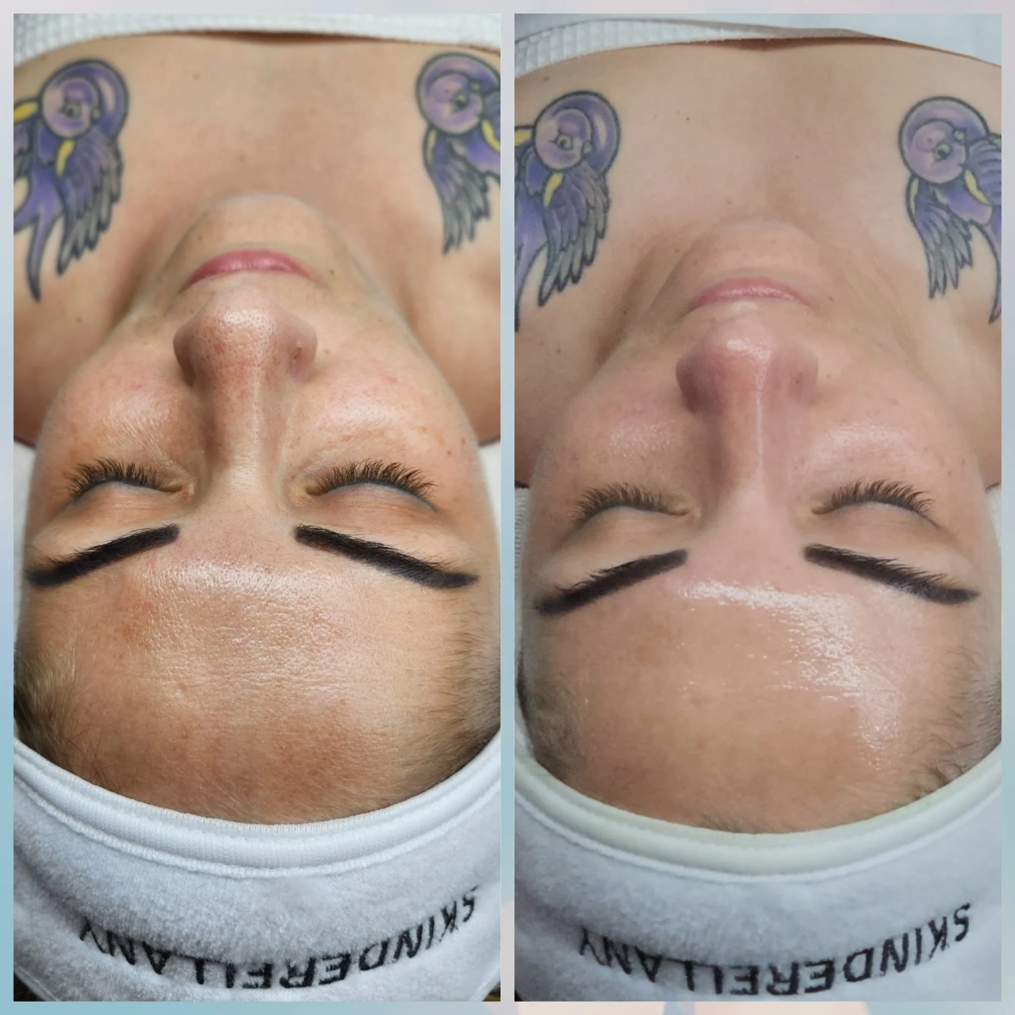 Comparison of a woman's face before and after skincare treatment, showing improved skin texture and appearance.