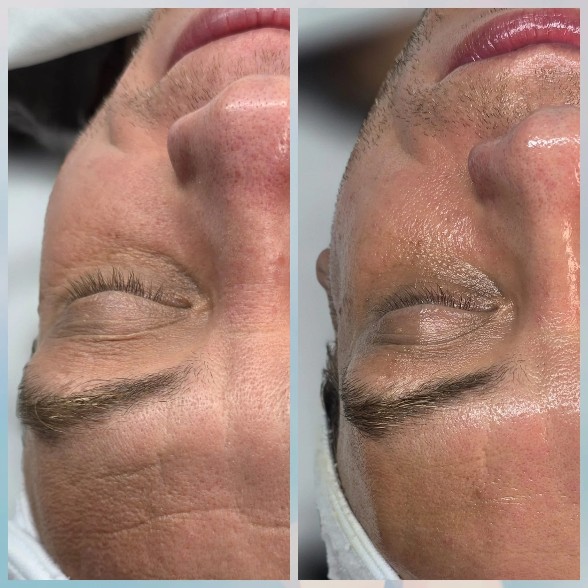 Comparison of a man's face before and after skin treatment, showing smoother and clearer skin on the right side.