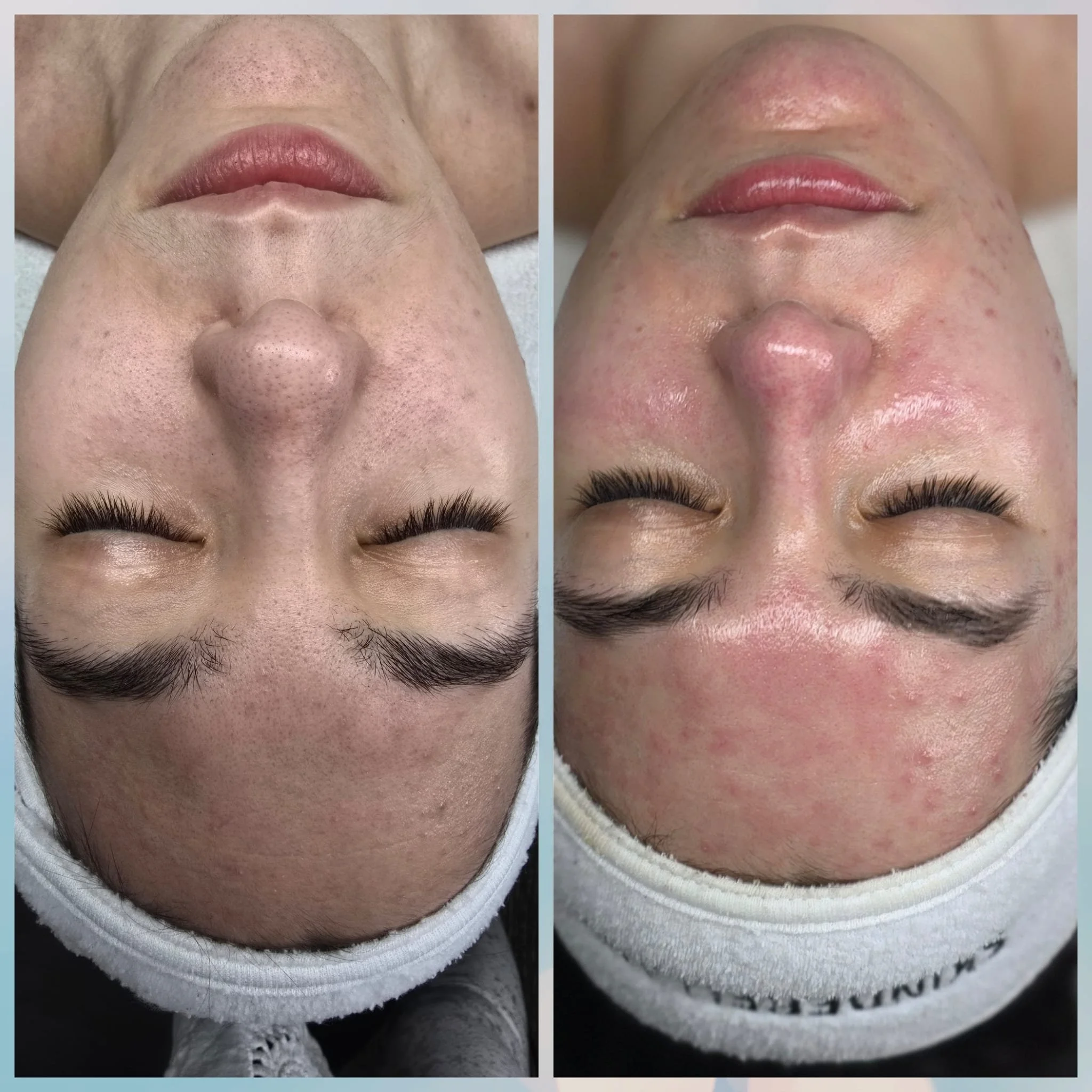 Comparison of a person's face before and after skincare treatment, showing reduced pores and improved skin texture.