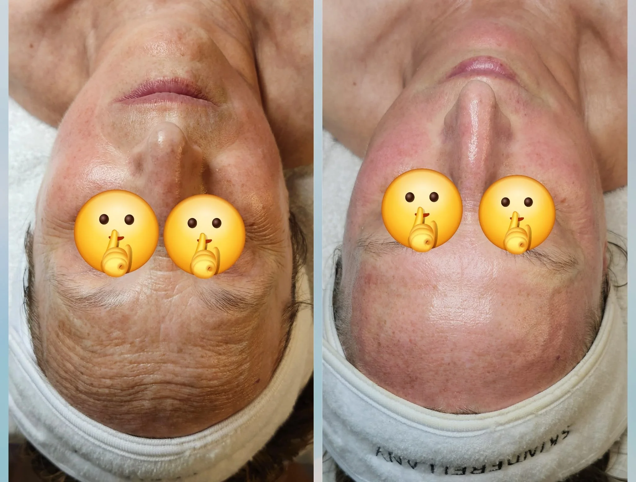 Comparison of a person's forehead before and after skincare treatment, showing reduced wrinkles and improved skin texture, with shush emojis covering the eyes.