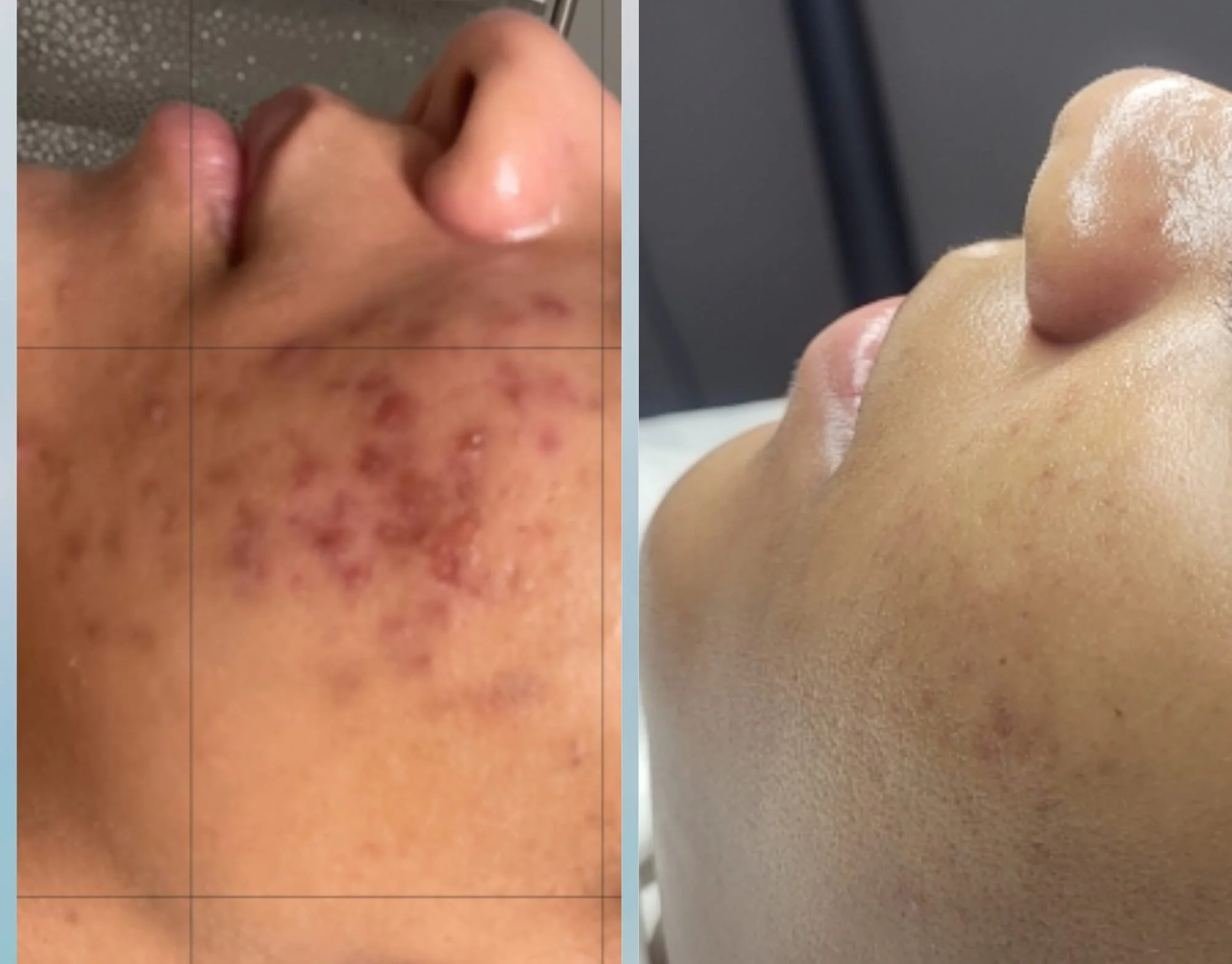 Comparison of a person's face before and after skin treatment, showing improvement in acne scars and skin texture.