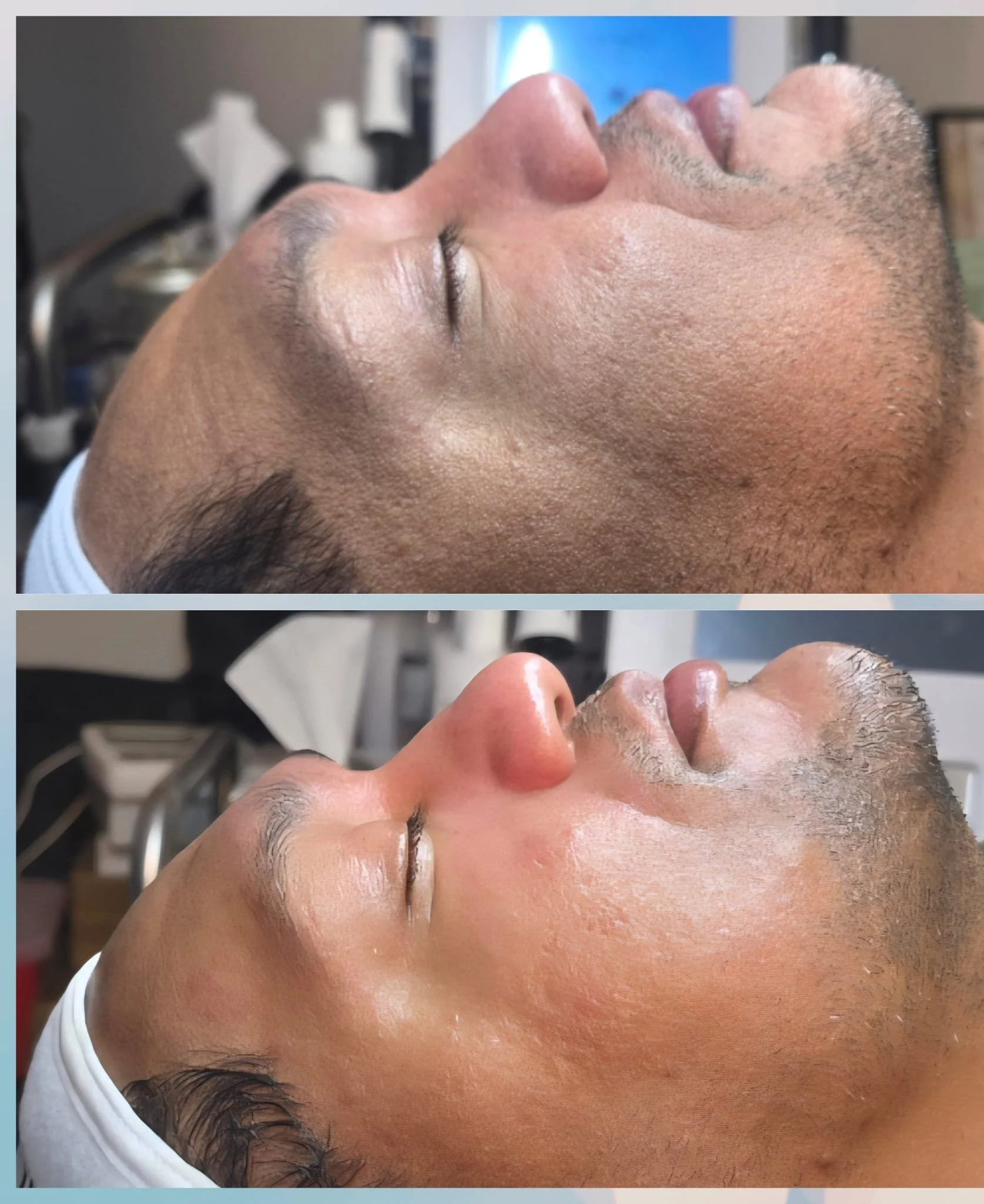 Before and after images showing a man's face during a skincare treatment, with visible improvement in skin smoothness and texture.