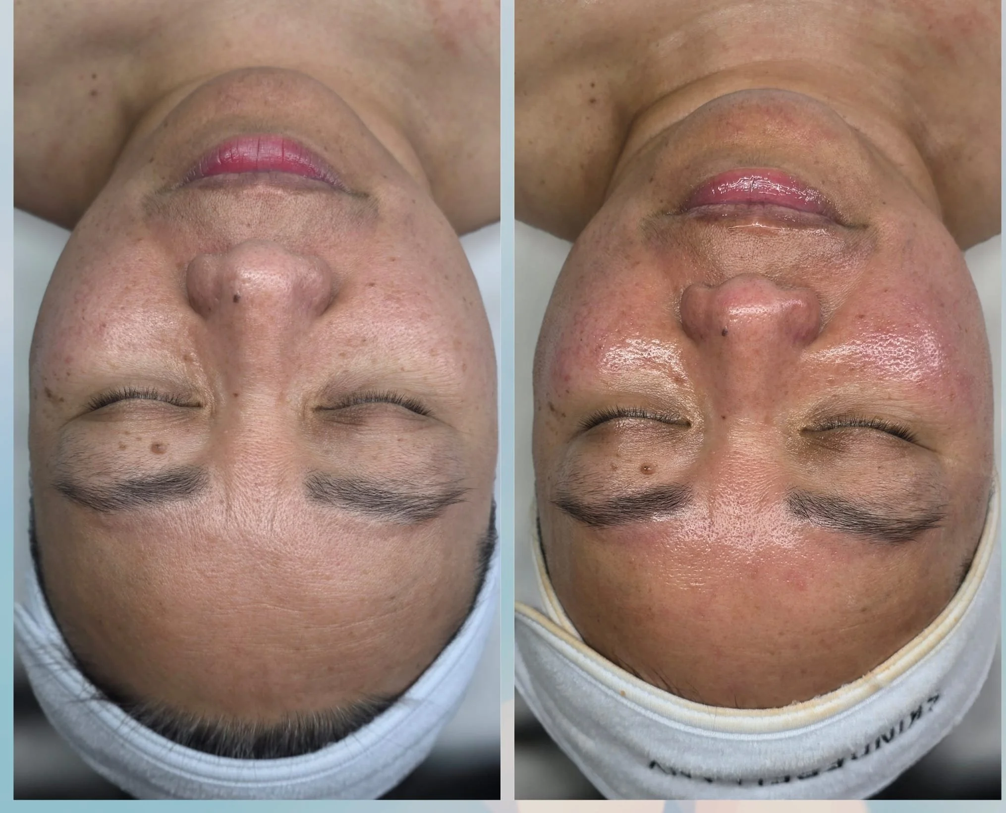 Side-by-side comparison of a person's face before and after a skincare treatment, showing improved skin texture, reduced redness, and a more even complexion.