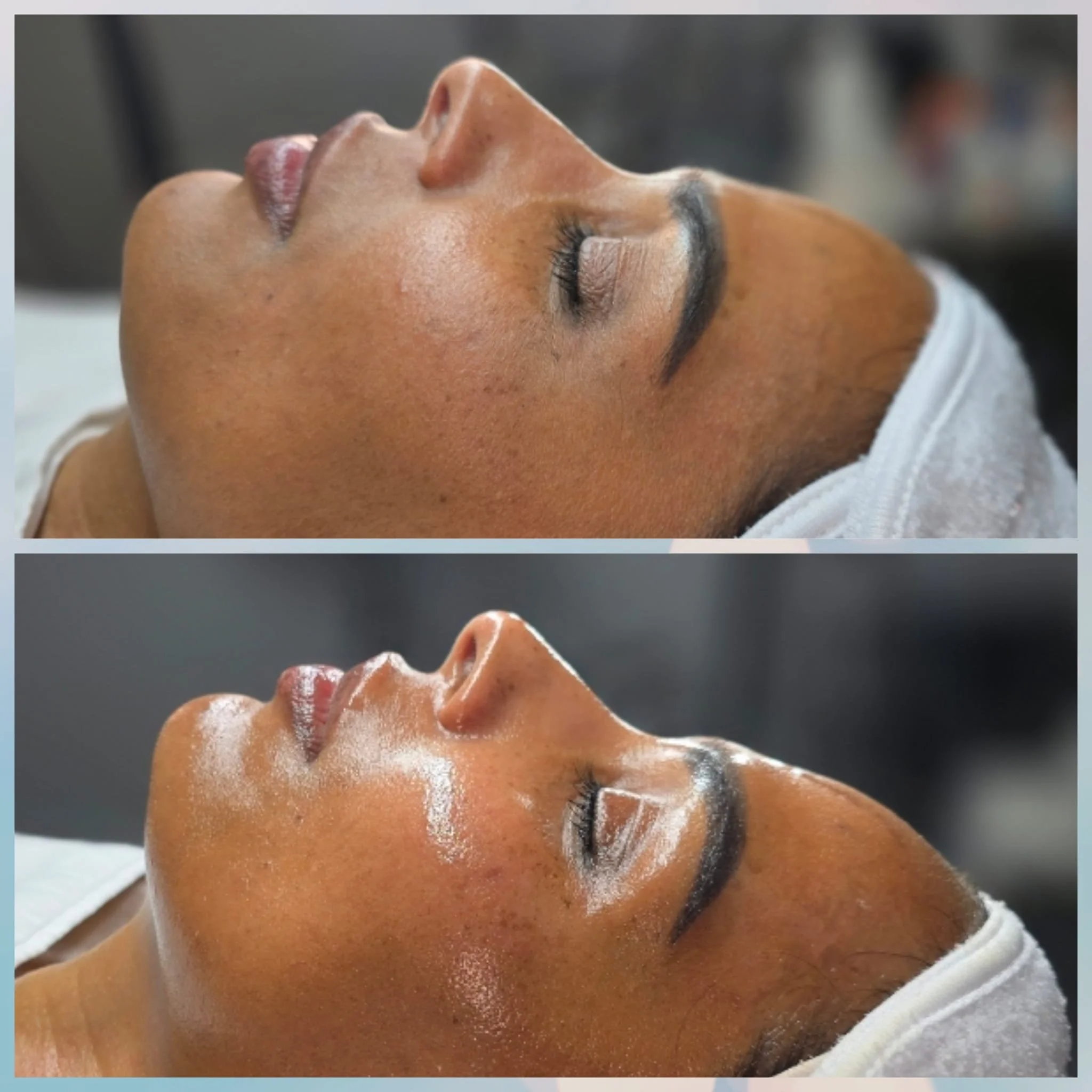 Before and after images of a woman receiving a skincare treatment, showing improved skin appearance with reduced pigmentation and enhanced glow.