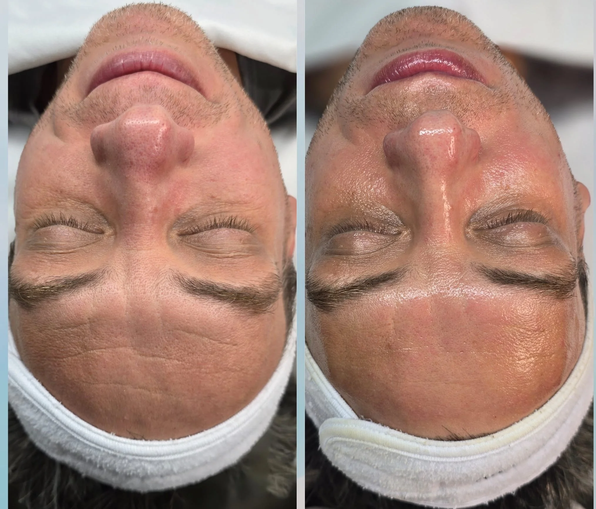 Side-by-side comparison of a man's face before and after a skincare treatment, showing improved skin texture and glow.