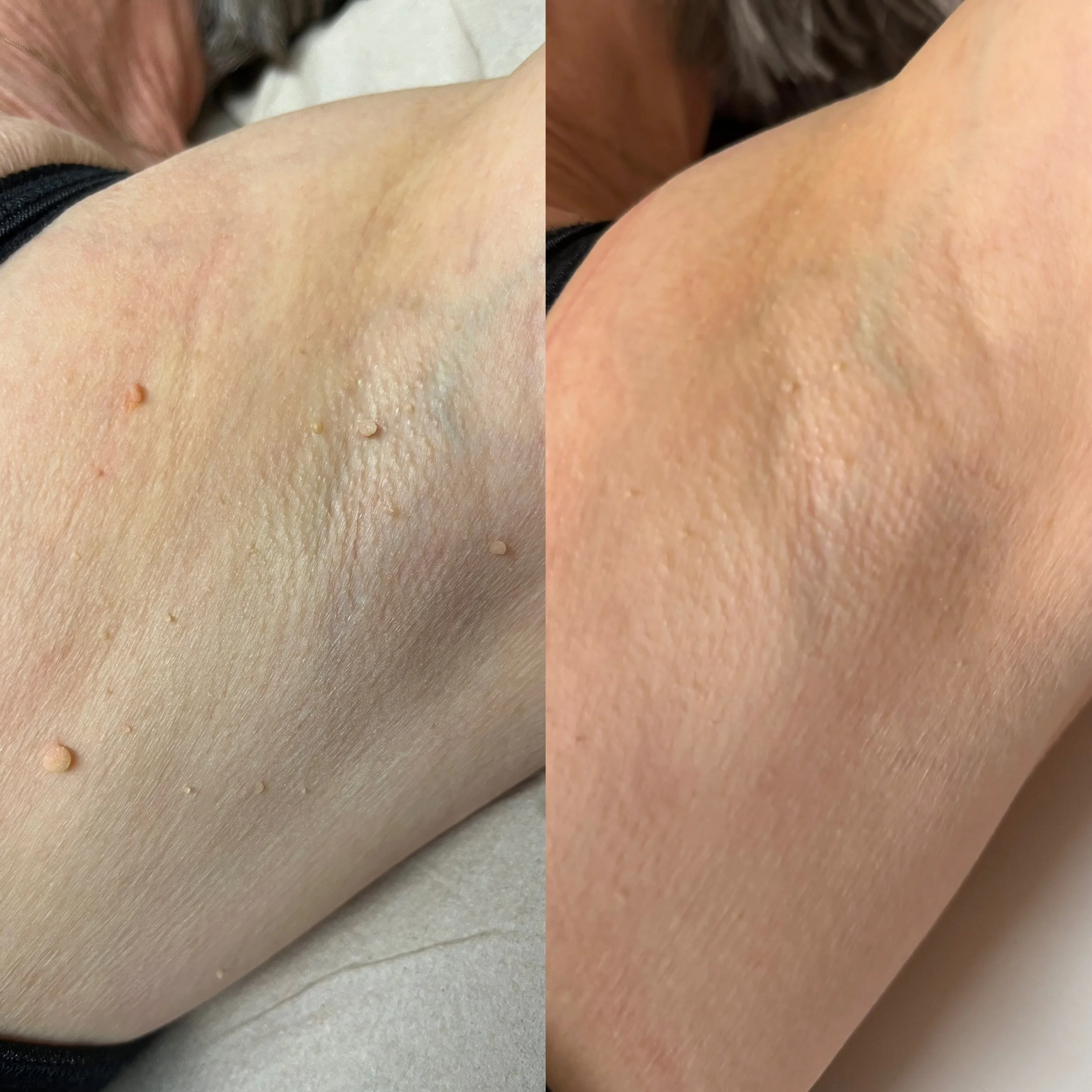 Armpit skin tag before and after removal using Cryopen at Bclear, near Sleaford, Ruskington in Lincolnshire.