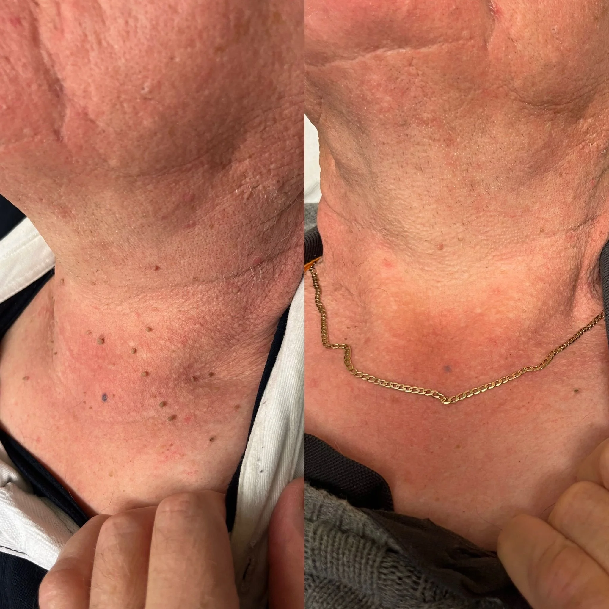 Skin tag removal before and after treatment at Bclear, Ruskington. Near Sleaford, Lincolnshire