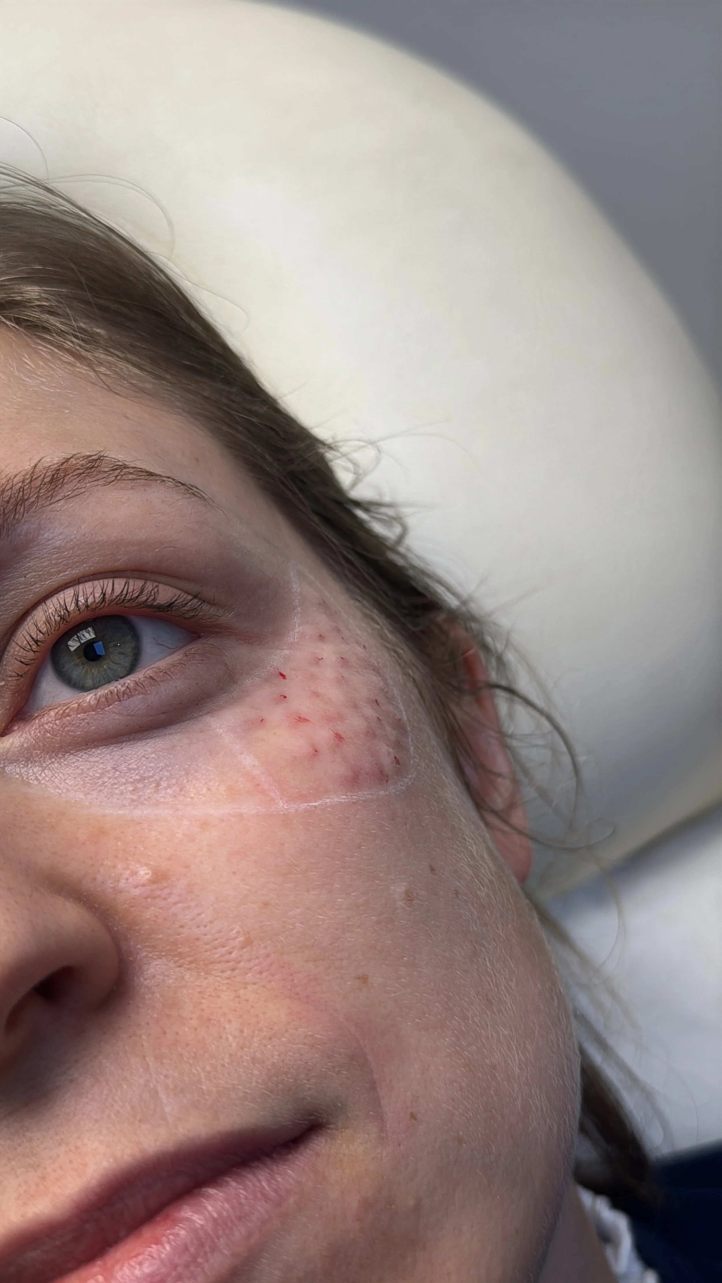 Resultado inmediato del tratamiento con bioestimuladores de colágeno en región periocular en una paciente, realizado en el Studio Maite Alvarez. Mejora el aspecto de la piel de la región periocular.