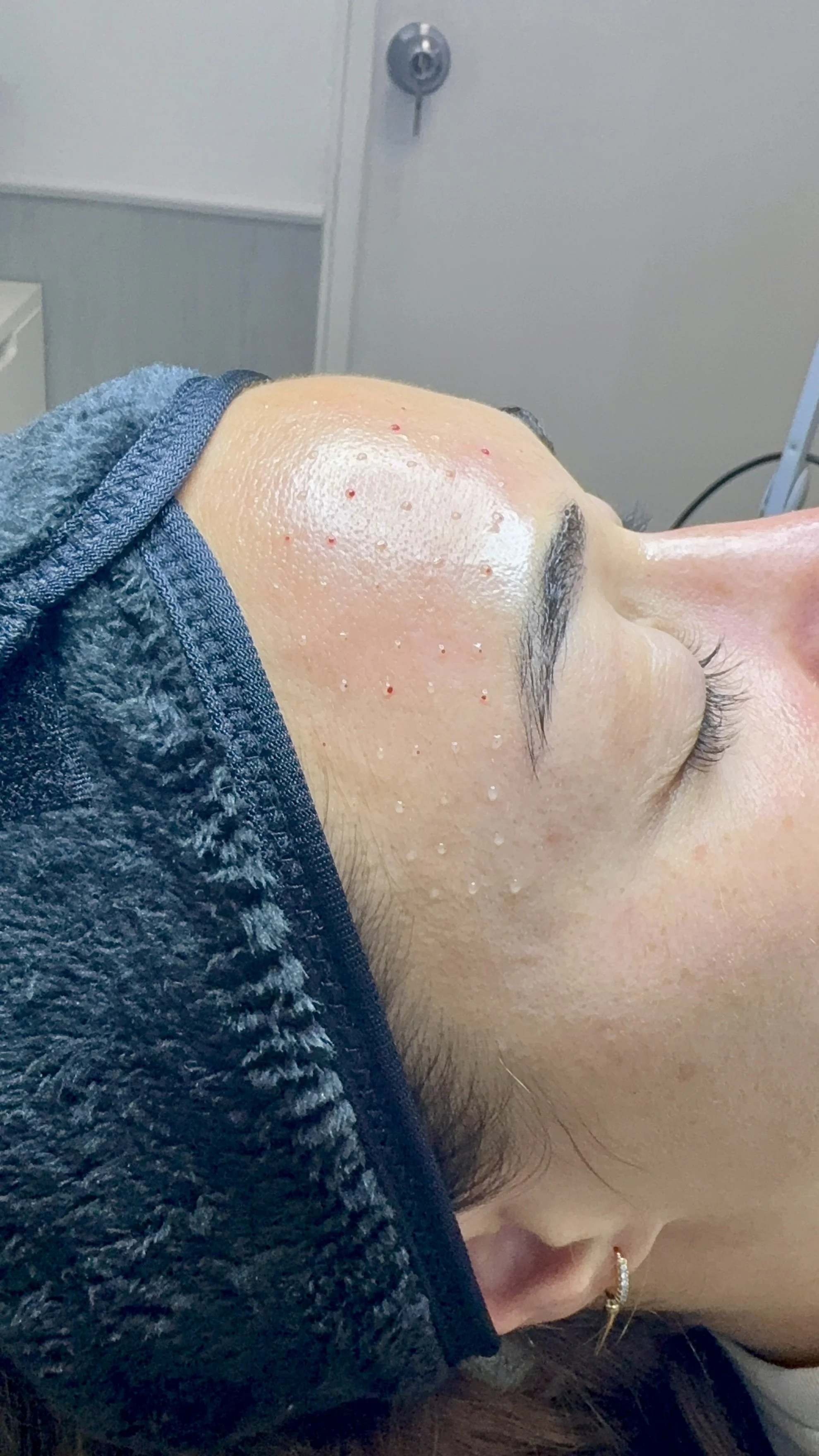 Paciente que la doctora Maite Alvarez le realizó mesoterapia facial, y se puede ver el procedimiento mientras se está realizando.