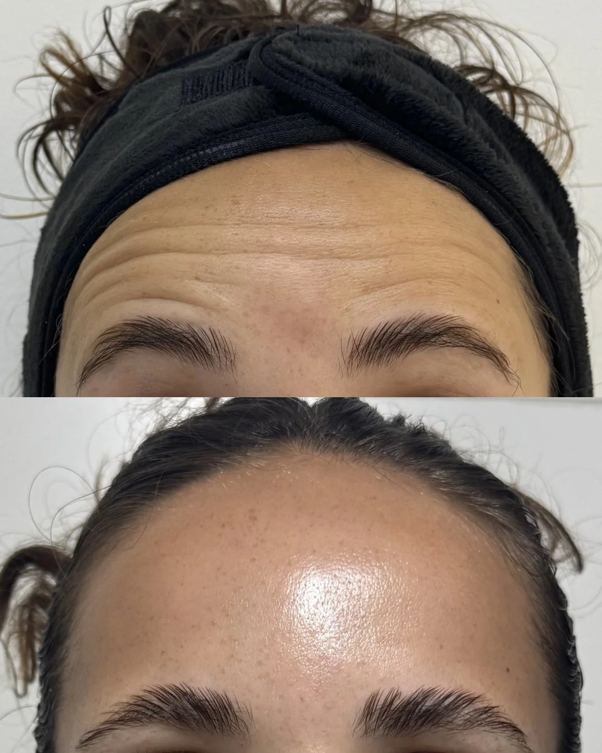 Resultado antes y después de tratamiento con toxina botulínica (botox) en frente de una paciente, realizado en el Studio Maite Alvarez. Resultados reales y naturales.