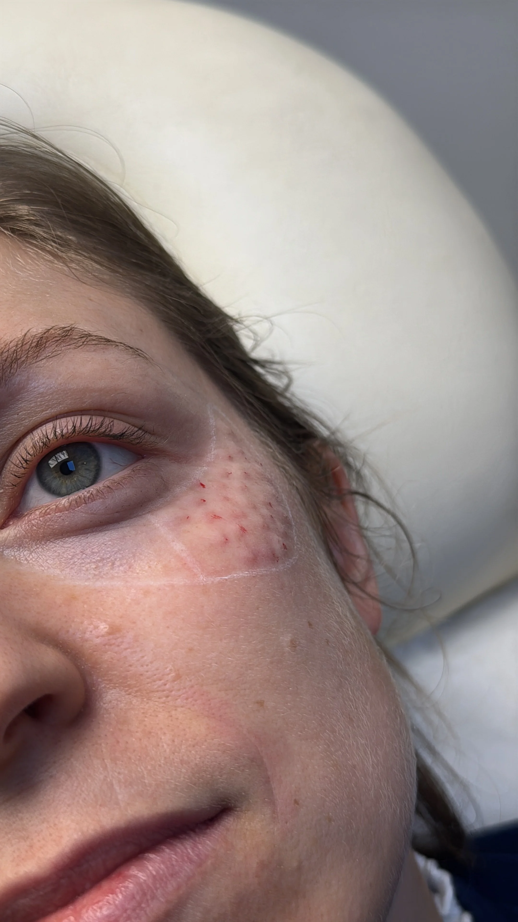 Resultado inmediato del tratamiento con bioestimuladores de colágeno en región periocular en una paciente, realizado en el Studio Maite Alvarez. Mejora el aspecto de la piel de la región periocular.