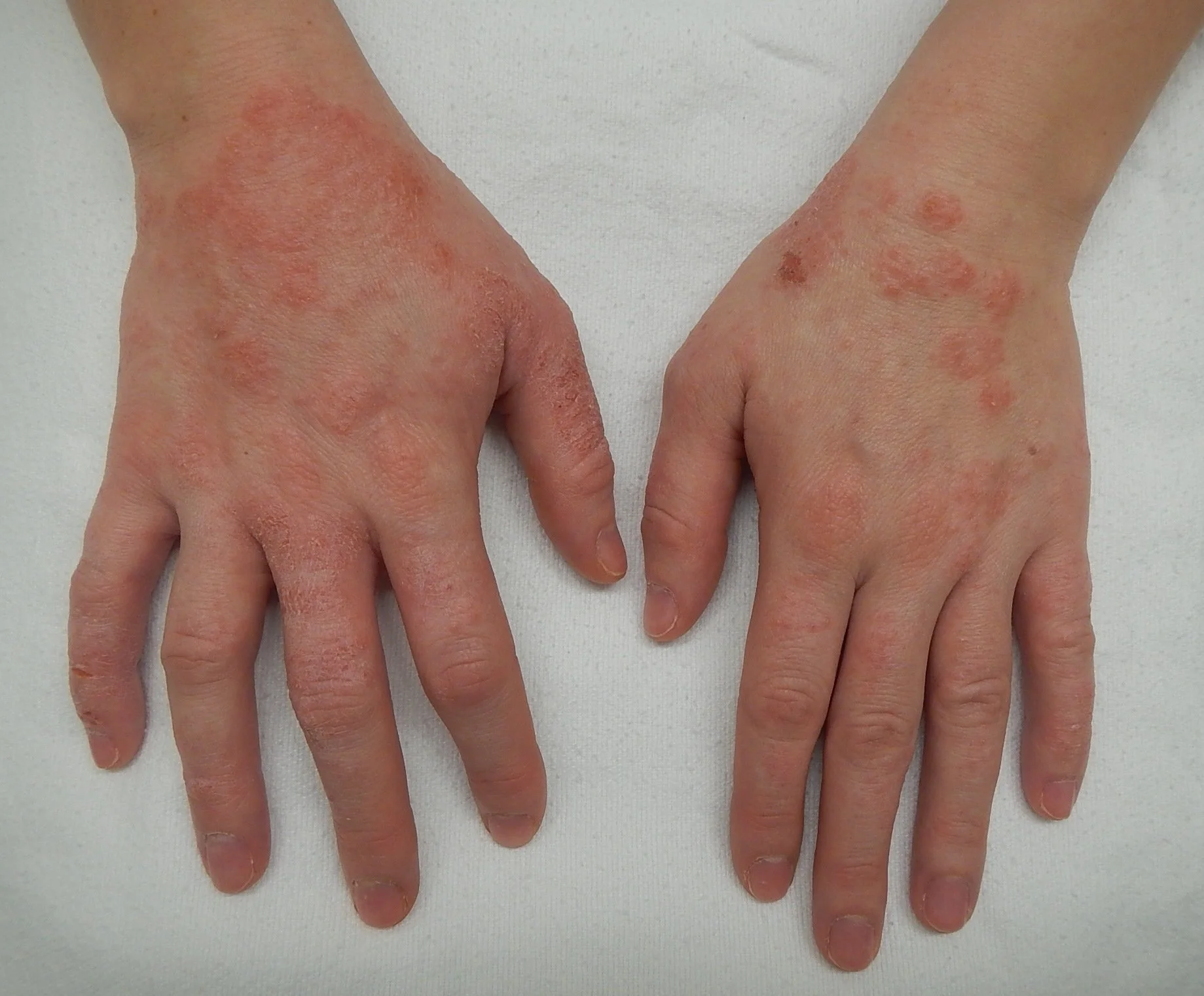 Clinical presentation of atopic dermatitis (eczema) showing dry, inflamed, irritated skin with redness and scaling on the arm. Image used for educational purposes regarding eczema symptoms and skin inflammation.