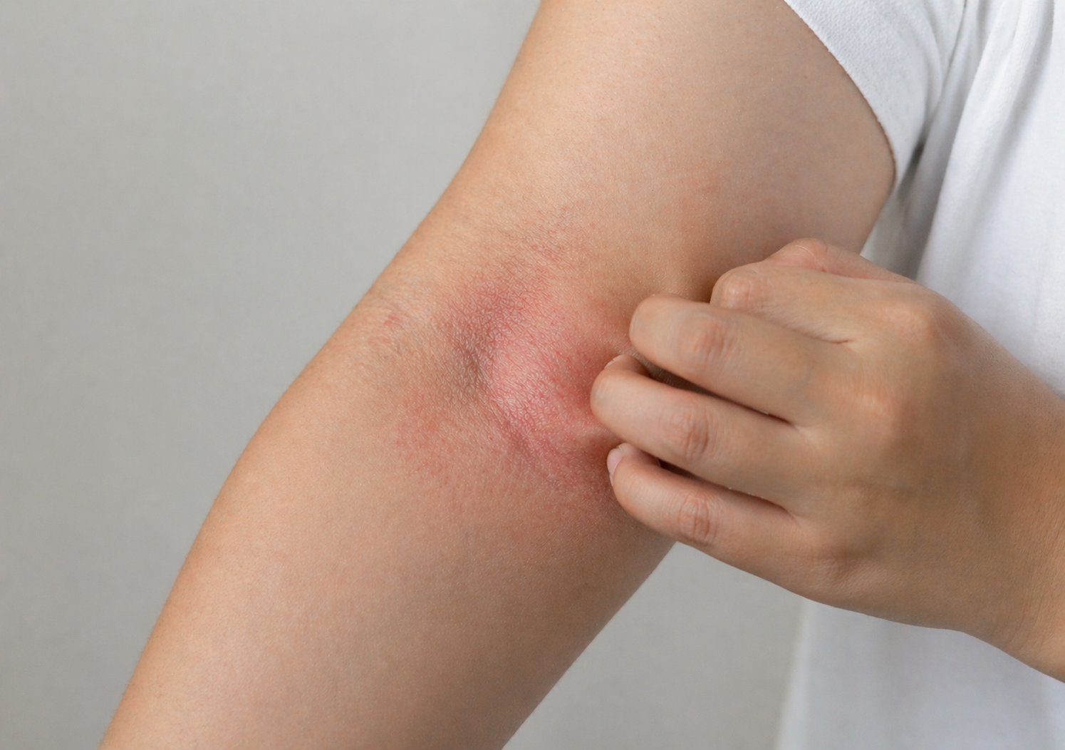 Acupuncture for Eczema: How It Relieves Itching, Inflammation &amp; Flare-Ups