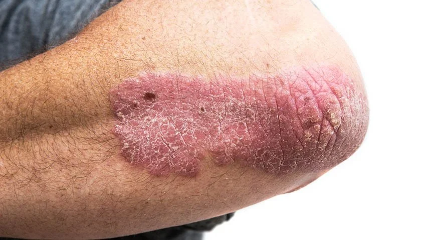 Close-up of plaque psoriasis on the elbow showing thick red inflamed skin with dry silvery scaling and cracking.