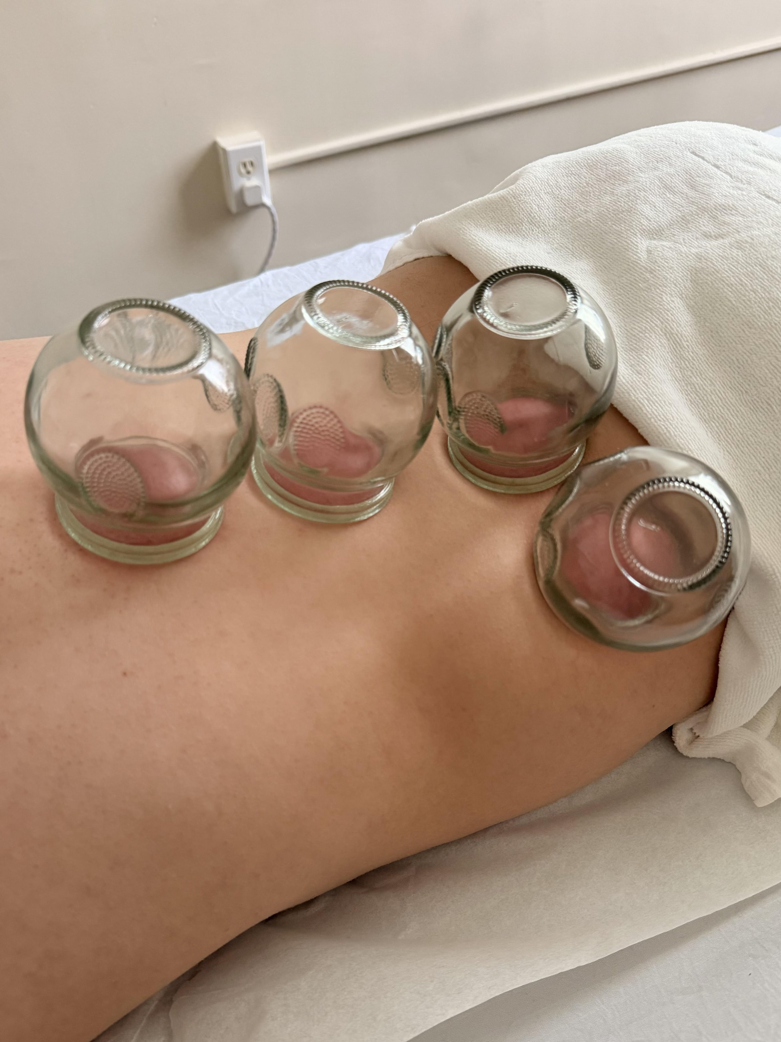 Traditional cupping therapy to improve circulation and relieve tension