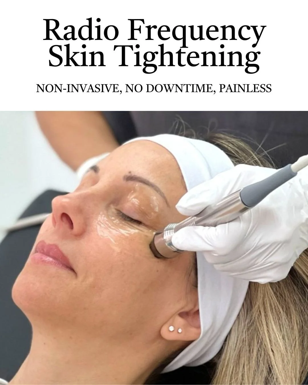 Lift. Tighten. Glow &mdash; No injectables. No surgery. No downtime. Only results.

Radio-frequency (RF) Rejuvenation &mdash;
RF technology gently heats the deeper layers of the skin to stimulate natural collagen and elastin production. 

&bull; Prog