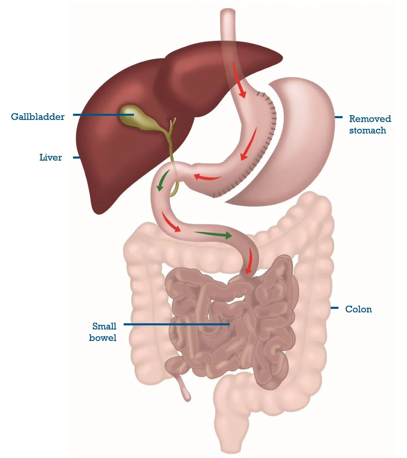 Diagram of the human digestive system showing a removed stomach, with arrows indicating the flow of digestive contents through the esophagus, small intestine, and colon; labeled as liver, gallbladder, small bowel, and colon.