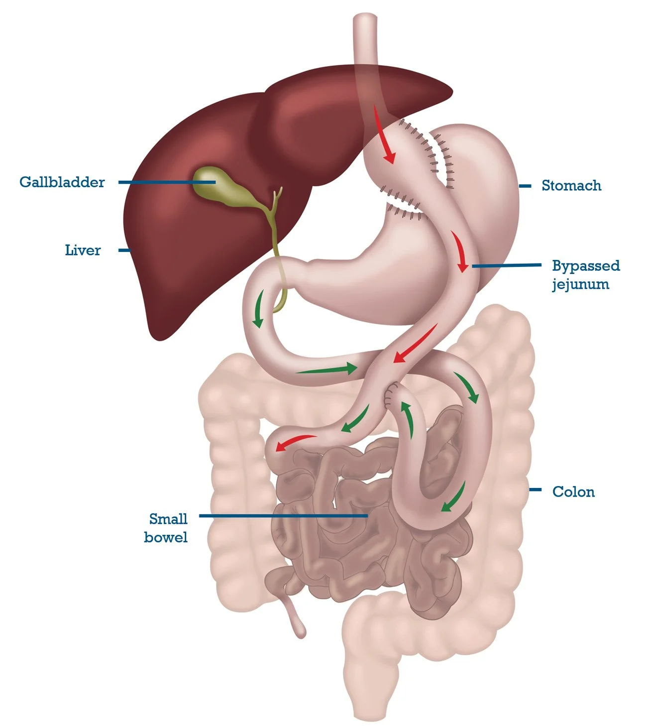 Diagram of the digestive tract showing the liver, gallbladder, stomach, bypassed jejunum, small bowel, and colon with red and green arrows indicating the flow of digestion.