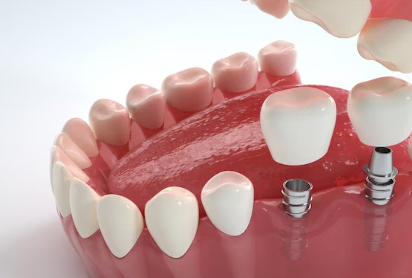 Multiple Teeth Dental Implants photo