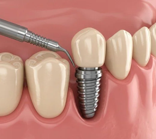 Single Tooth Replacement Dental Implants photo