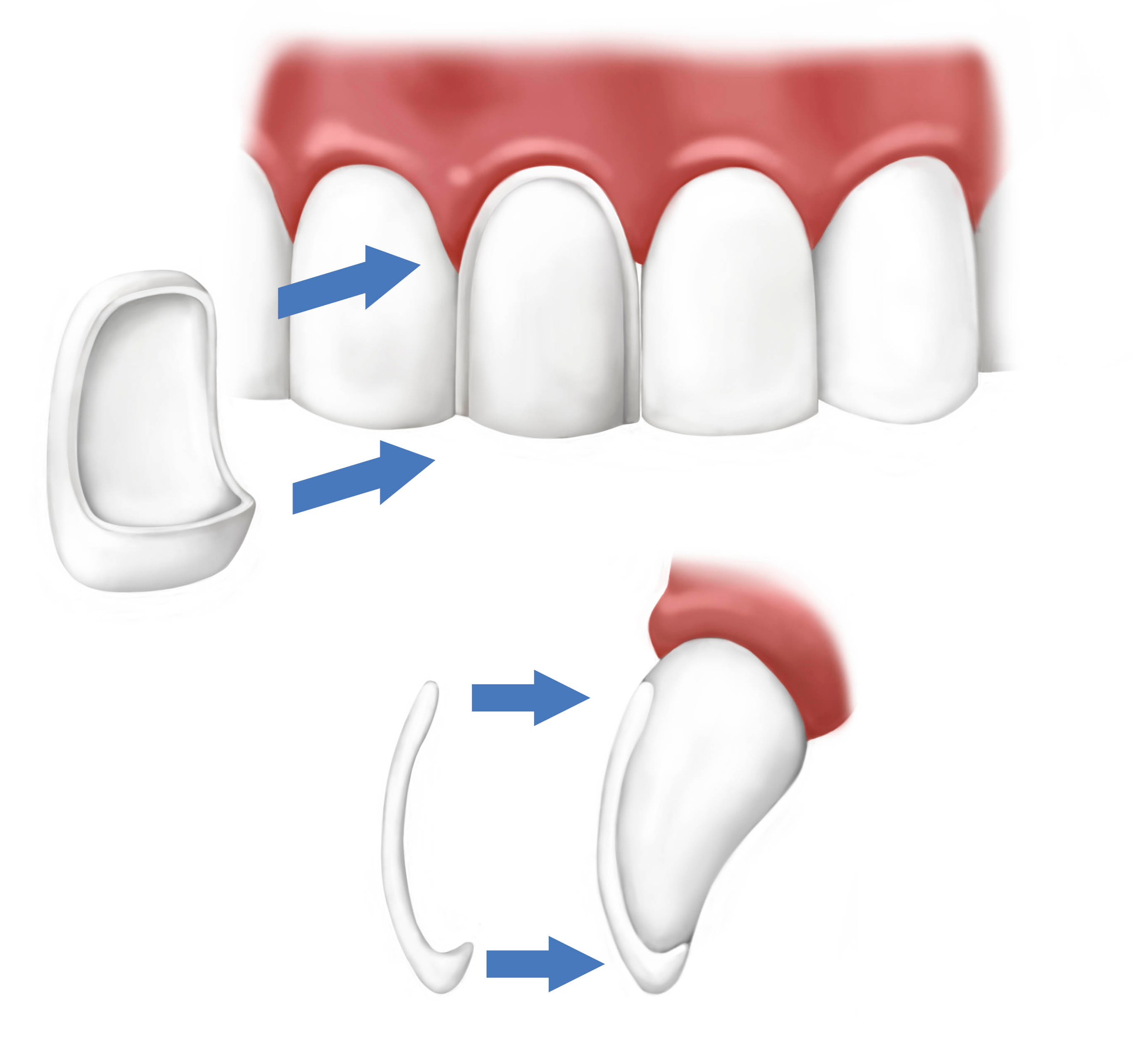 no prep veneers cost photo