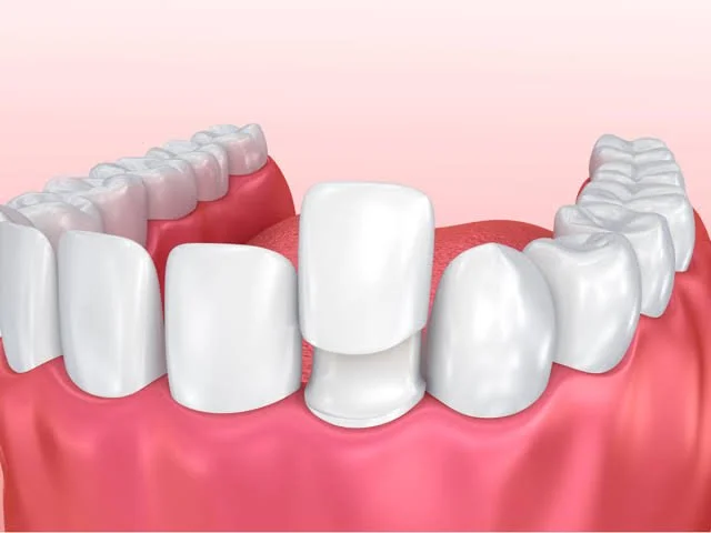 No-Prep Veneers photo
