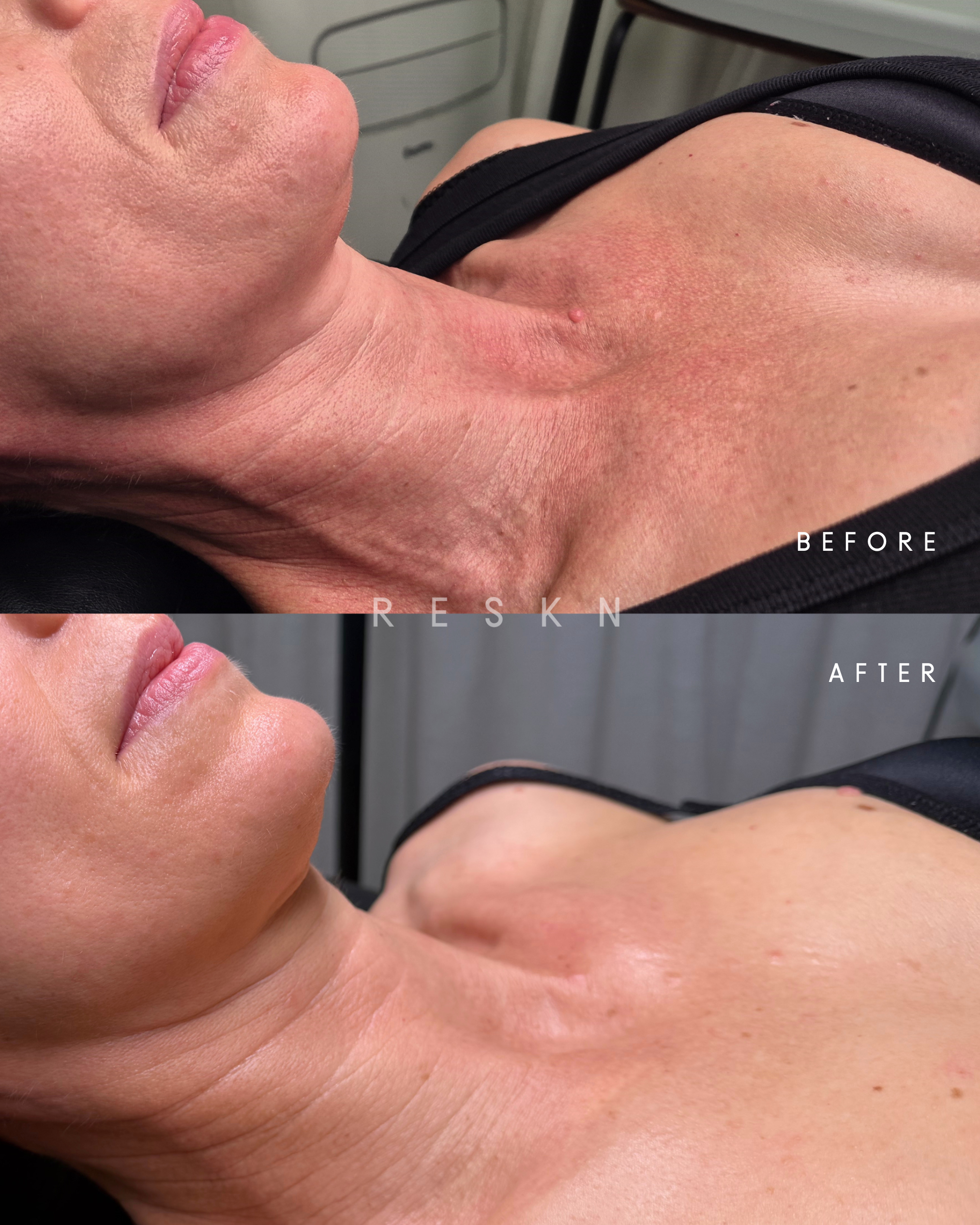 before after microneedling.