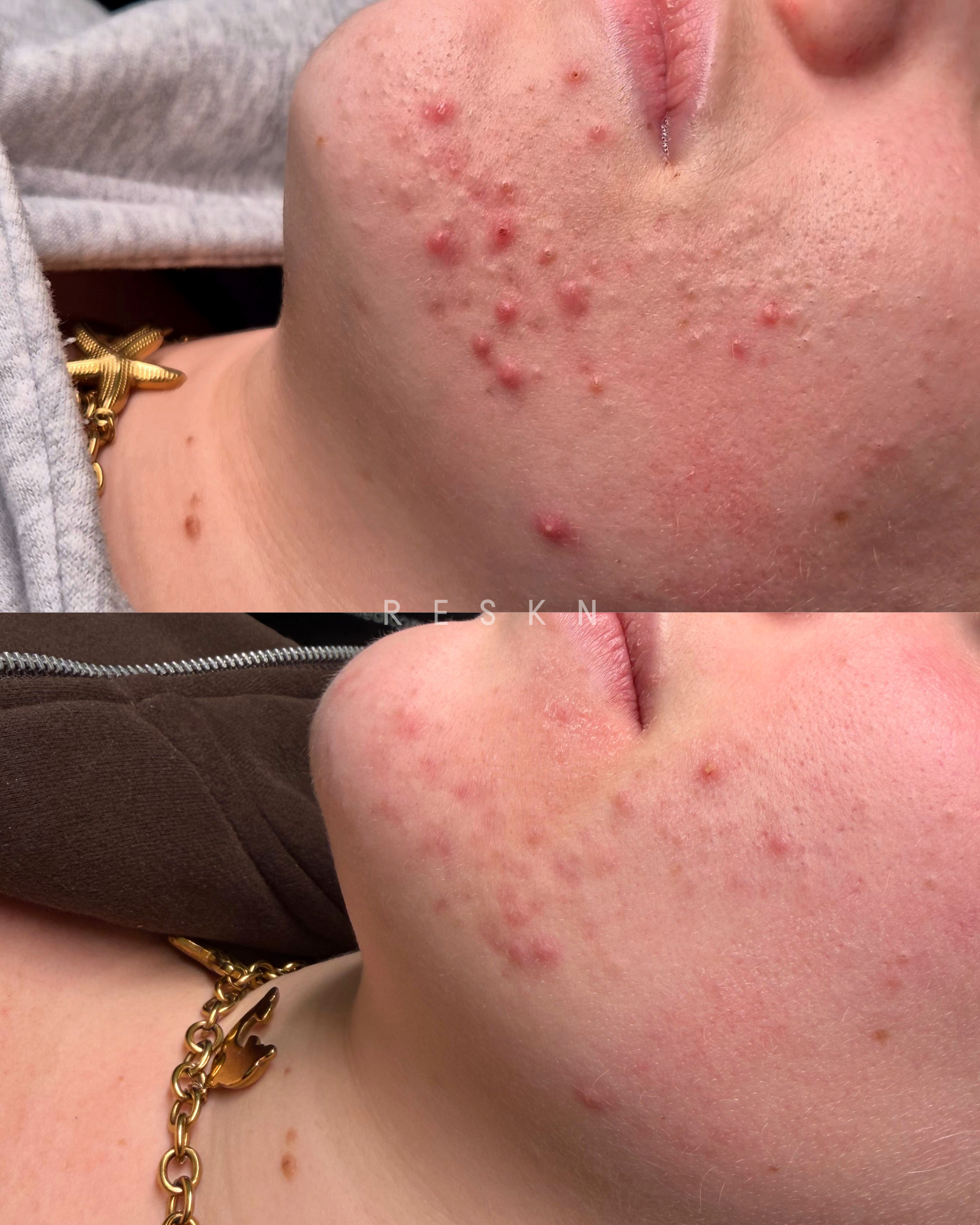 microneedling for acne