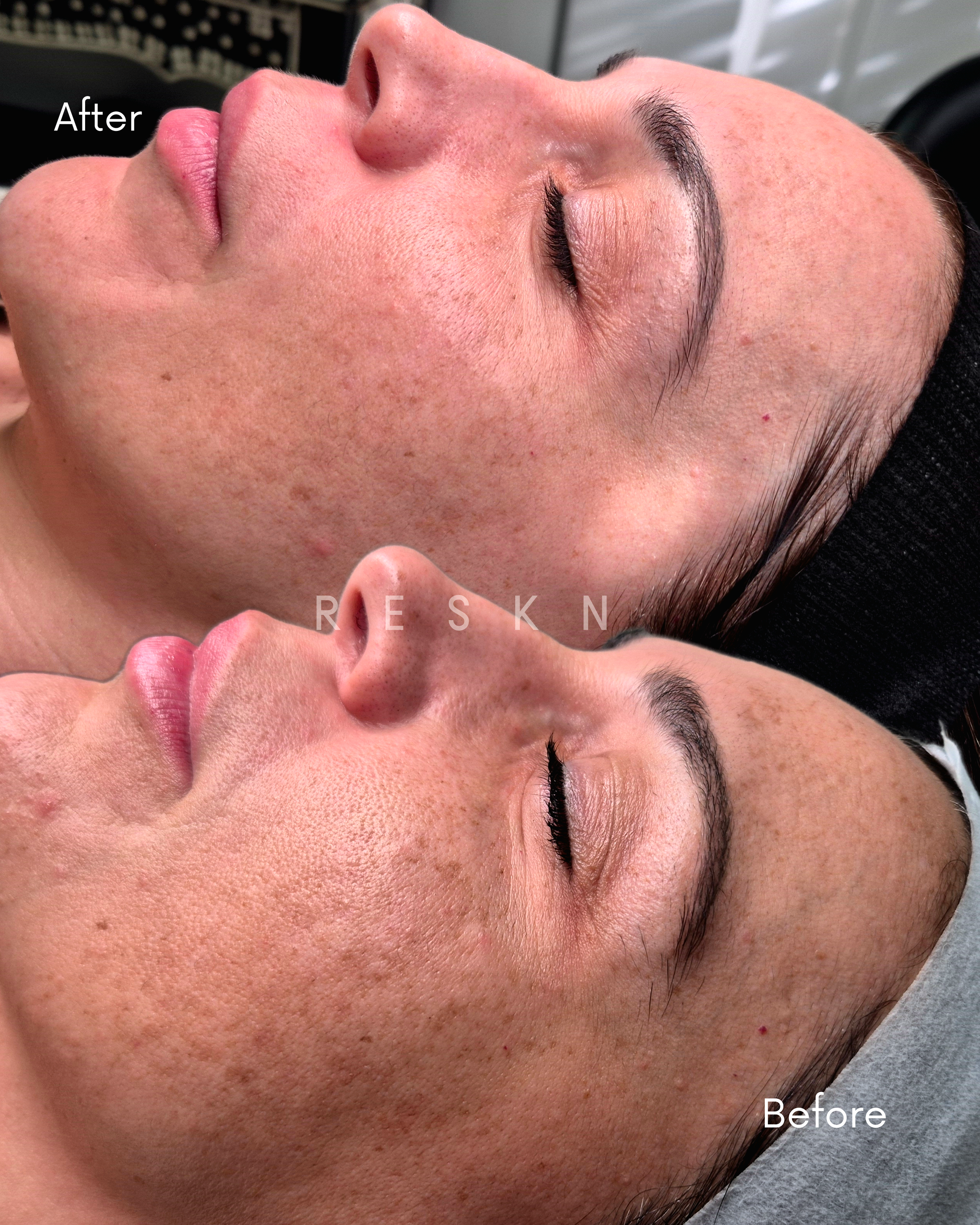 Before and After 3 advanced skin needling for pigmentation concerns