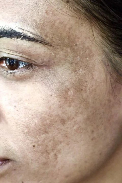 Pigmentation Won't Just Disappear… Here's What Actually Works