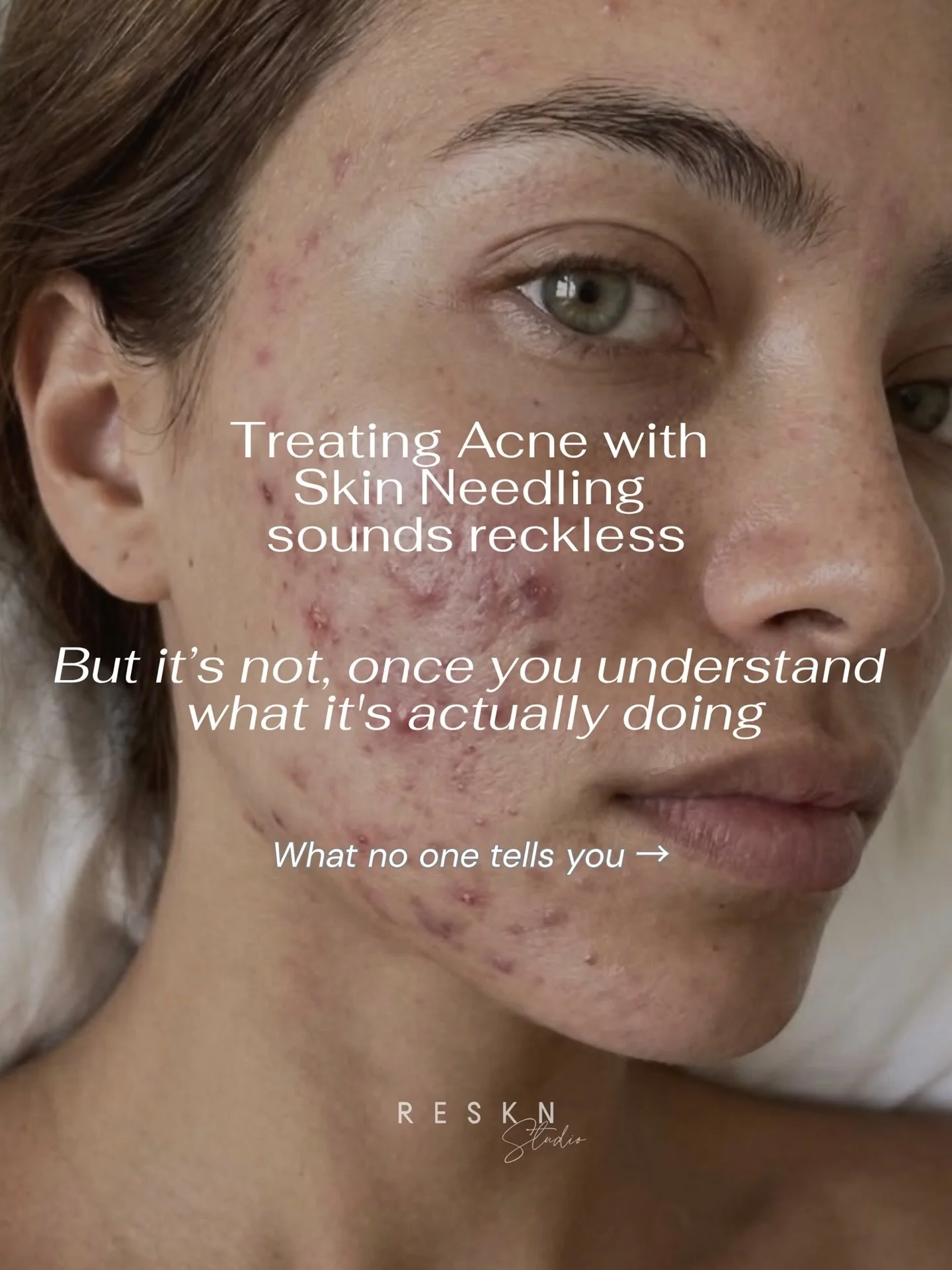 &ldquo;But doesn&rsquo;t skin needling spread bacteria?&rdquo; I hear this all the time.
But acne is far more complex than simply having bacteria on the skin.
So why are we so quick to write off skin needling for active acne without understanding how
