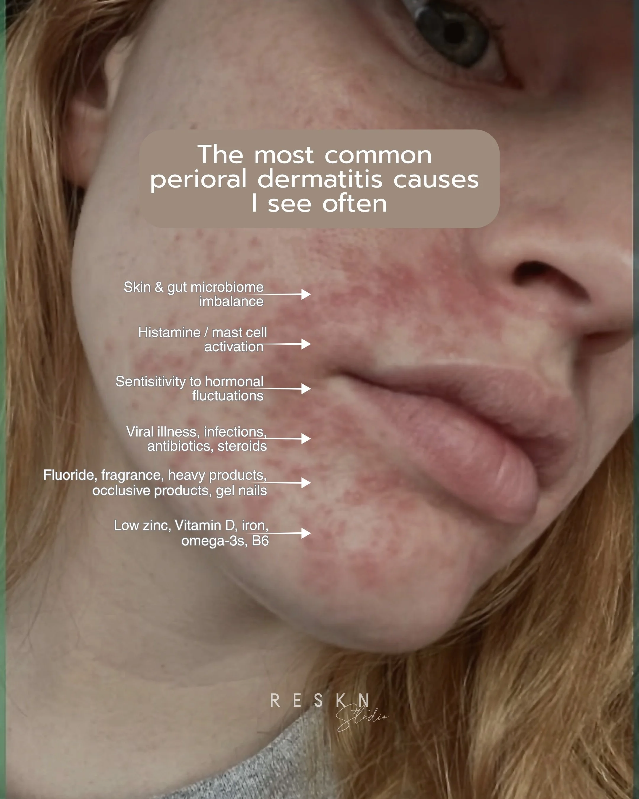 Perioral dermatitis is never just &ldquo;one trigger,&rdquo; and I wish more people knew that.
In my experience, it&rsquo;s usually a mix, things like microbiome imbalance, hormonal shifts, histamine reactions, certain medications, nutrient gaps, or 