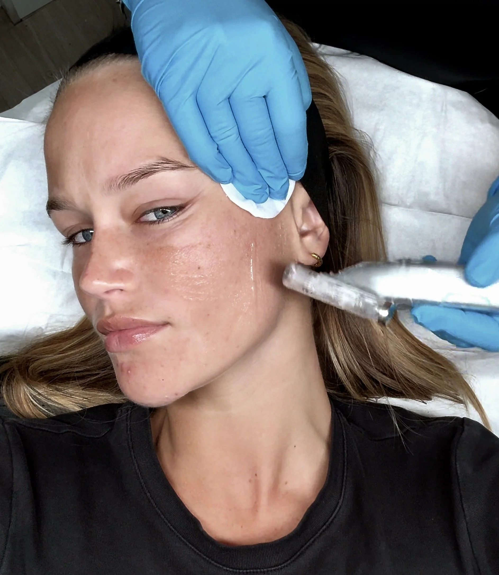 Advanced Skin Needling