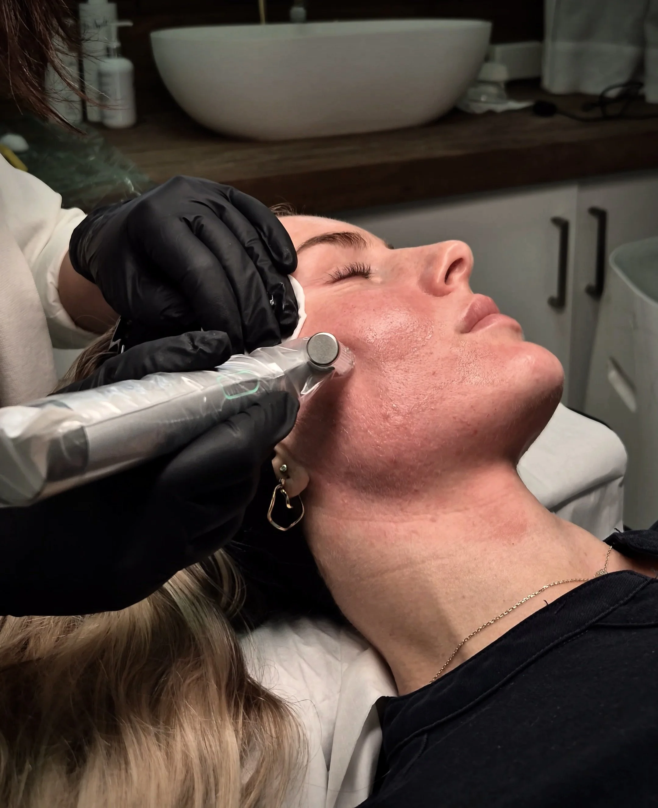 Advanced Skin Needling
