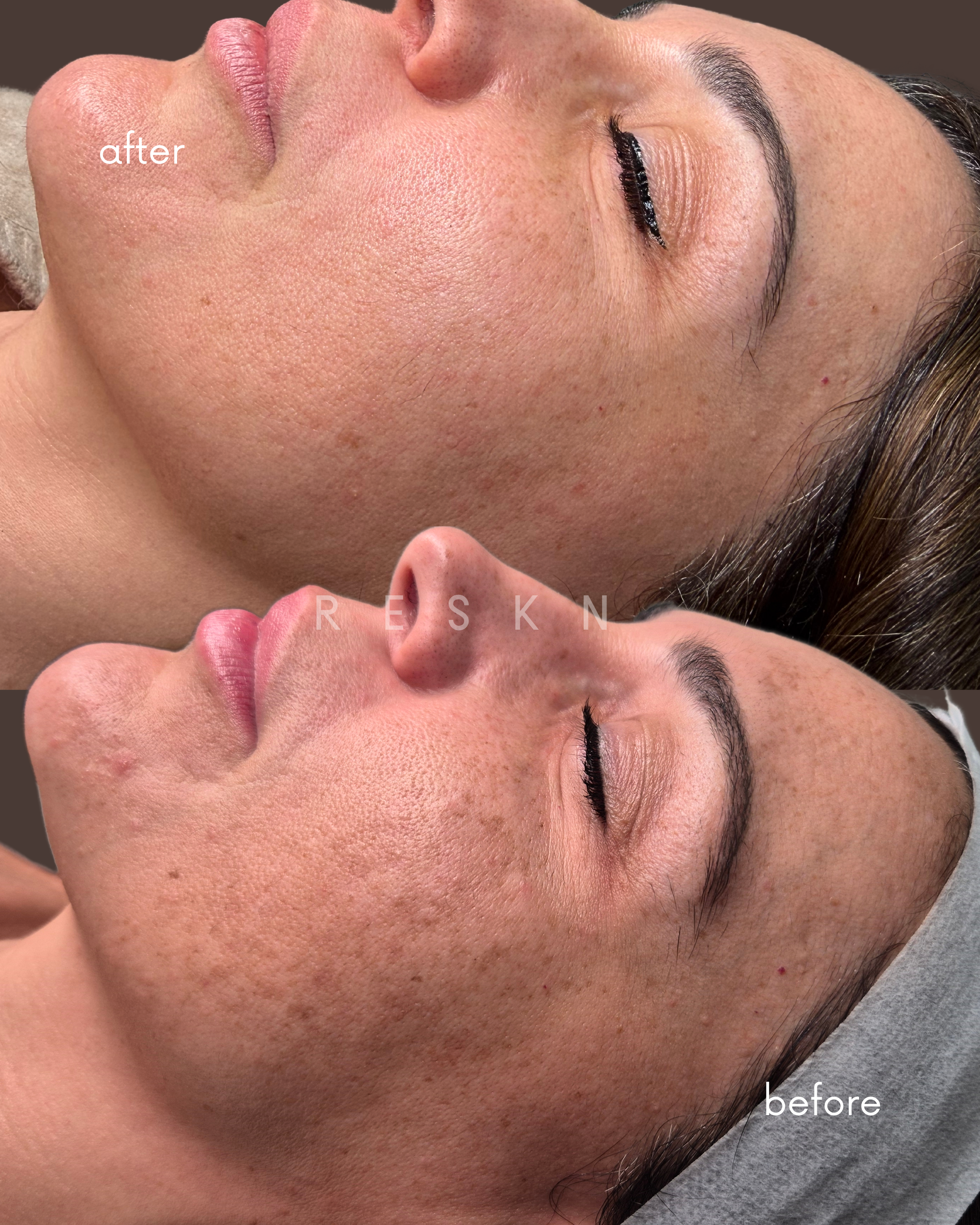 melasma b&a