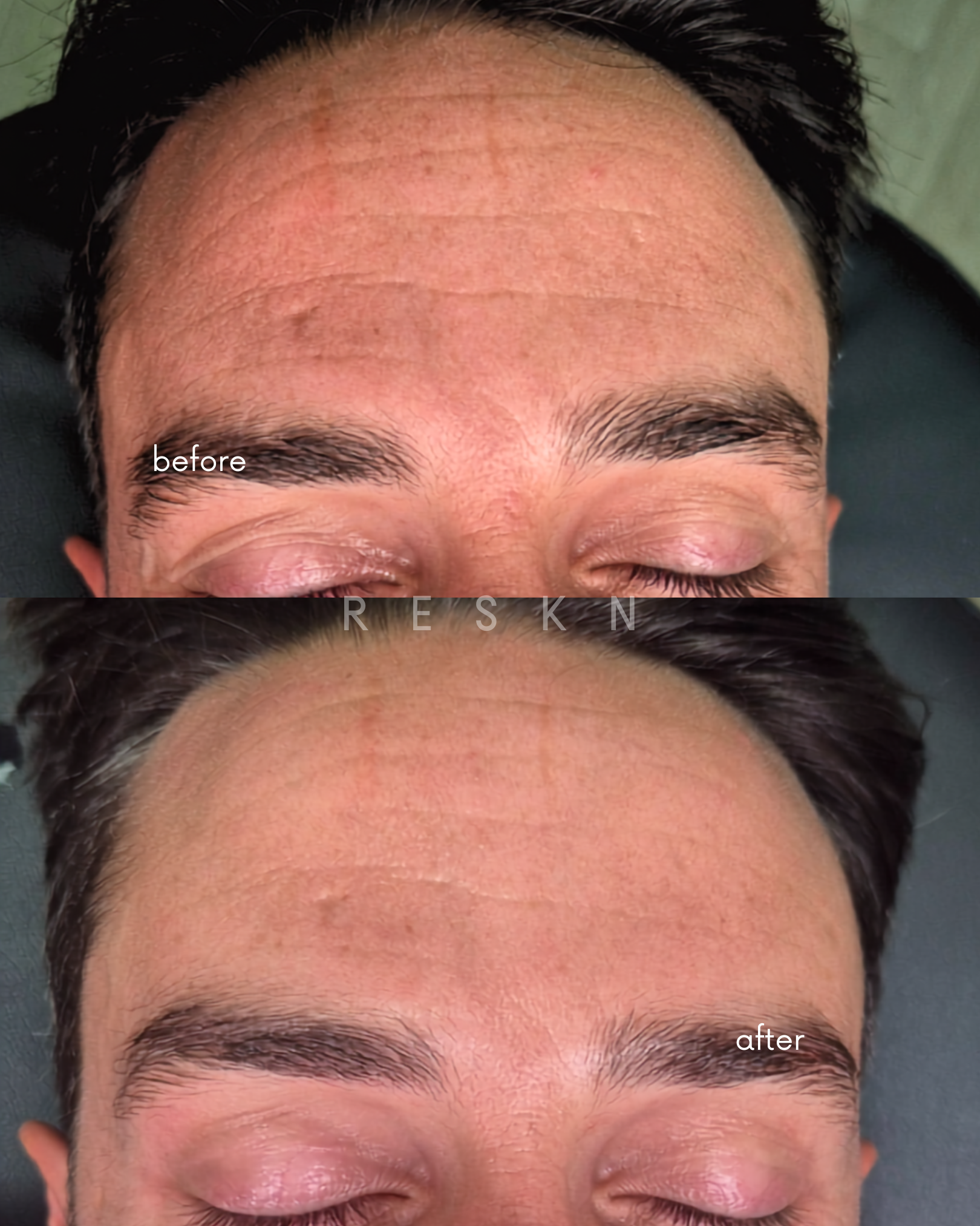 Before After Microneedling