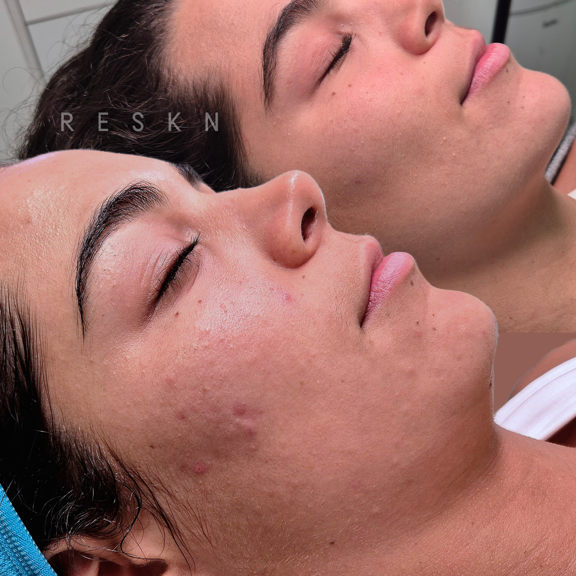 before and after 1 skin needling treatment for texture