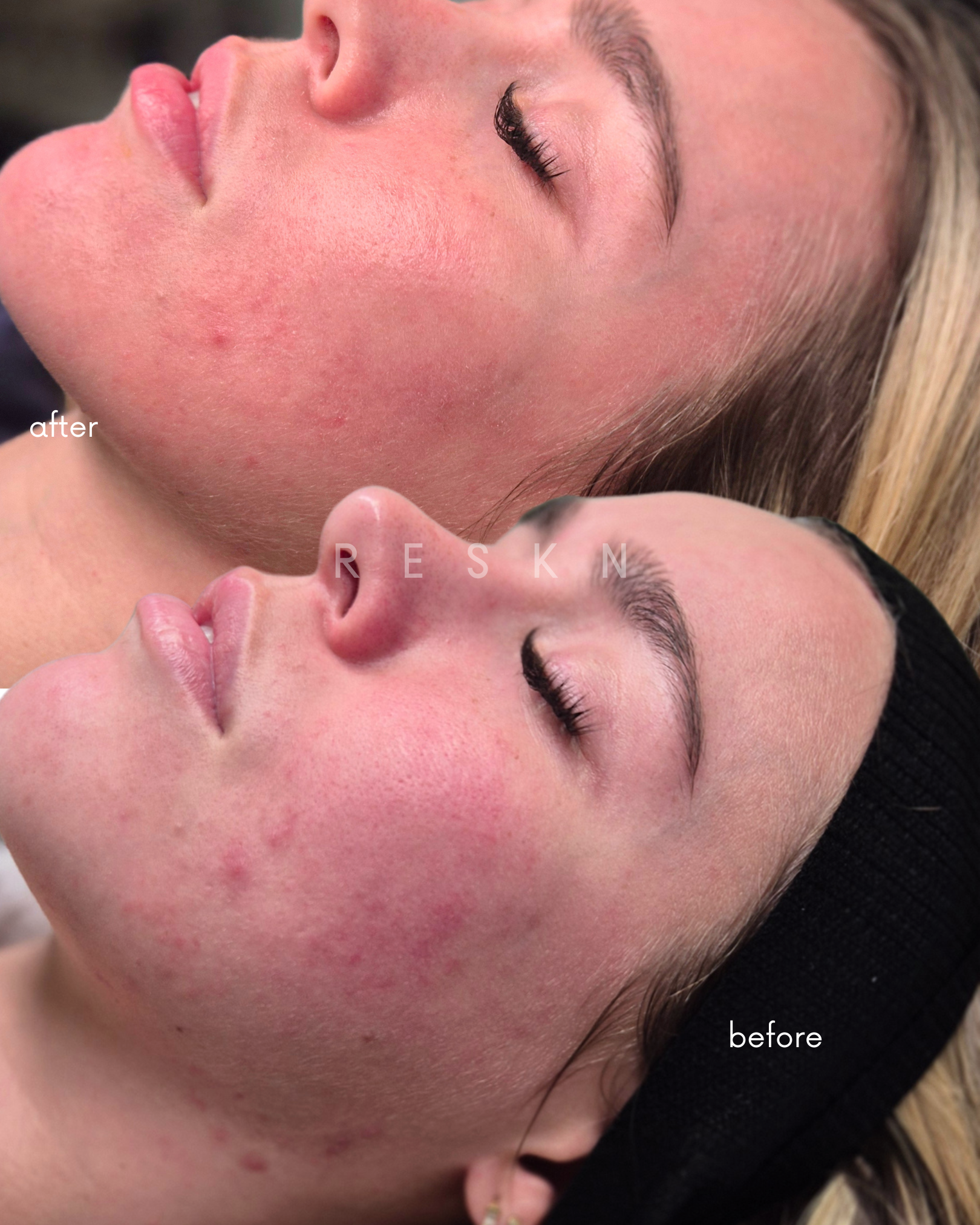 before after Skin Needling