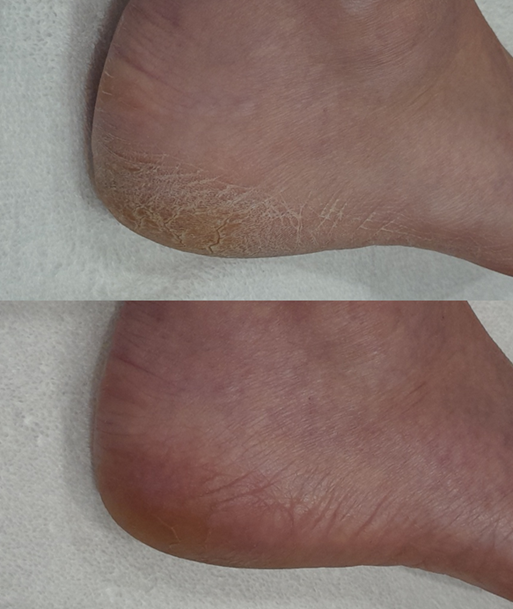 Comparison of a heel before and after treatment: the top shows dry, cracked skin, and the bottom shows smooth, healthy skin.