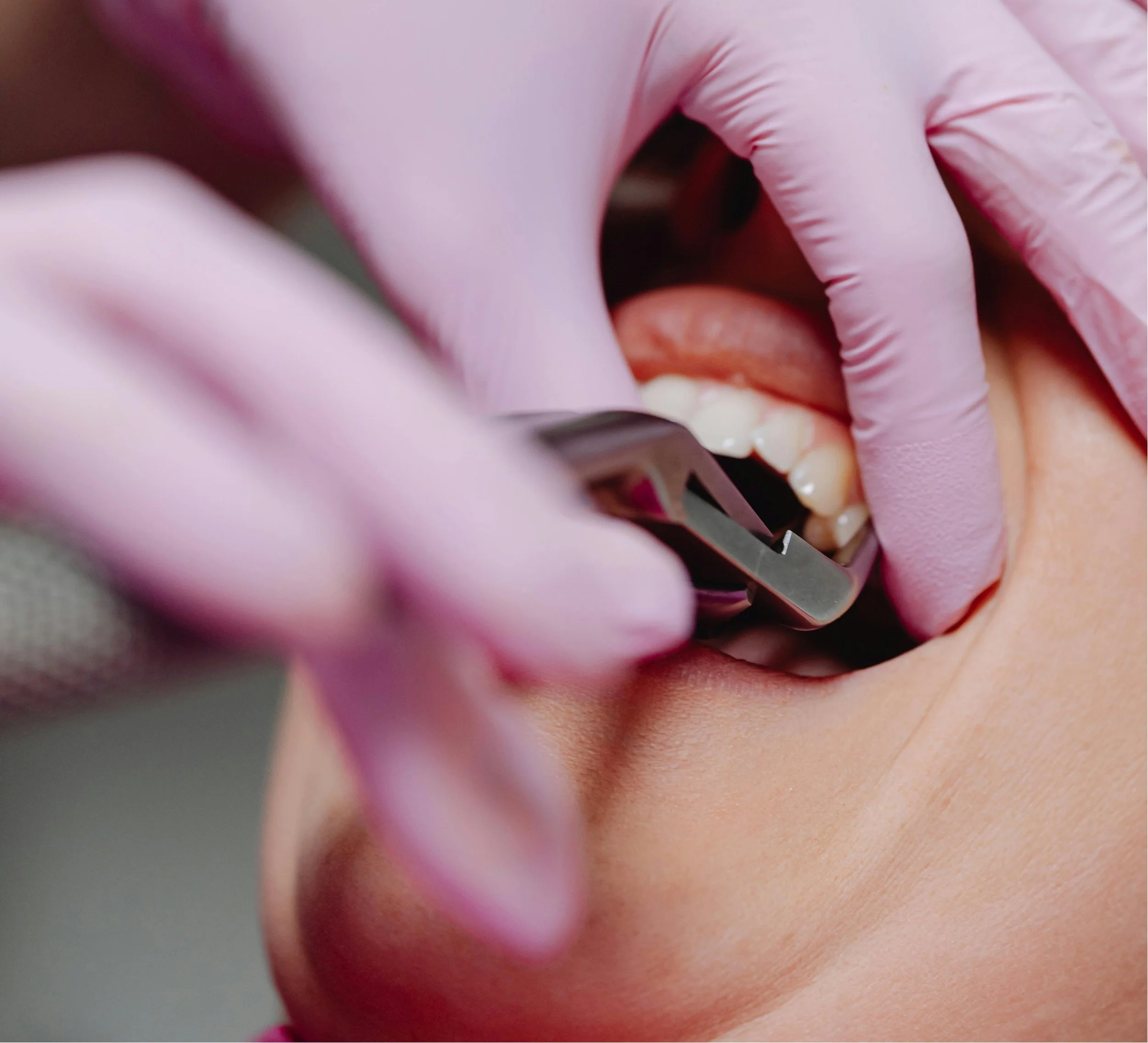 Extractions Dentaire