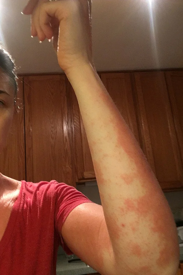 My body was so overburdened with toxins, unknown to me before learning about functional medicine that detox was painful and excruciating. This rash was an extreme reaction likely caused when mycotoxins were being released from my body.